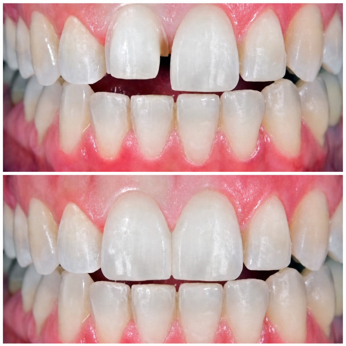 Avant et après facettes dentaires à Love Dental and Sthetic Clinic – sourire amélioré