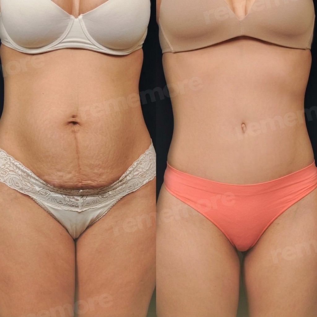 Before and after abdominal liposuction results at Memorial Bahçelievler Hospital, flatter stomach