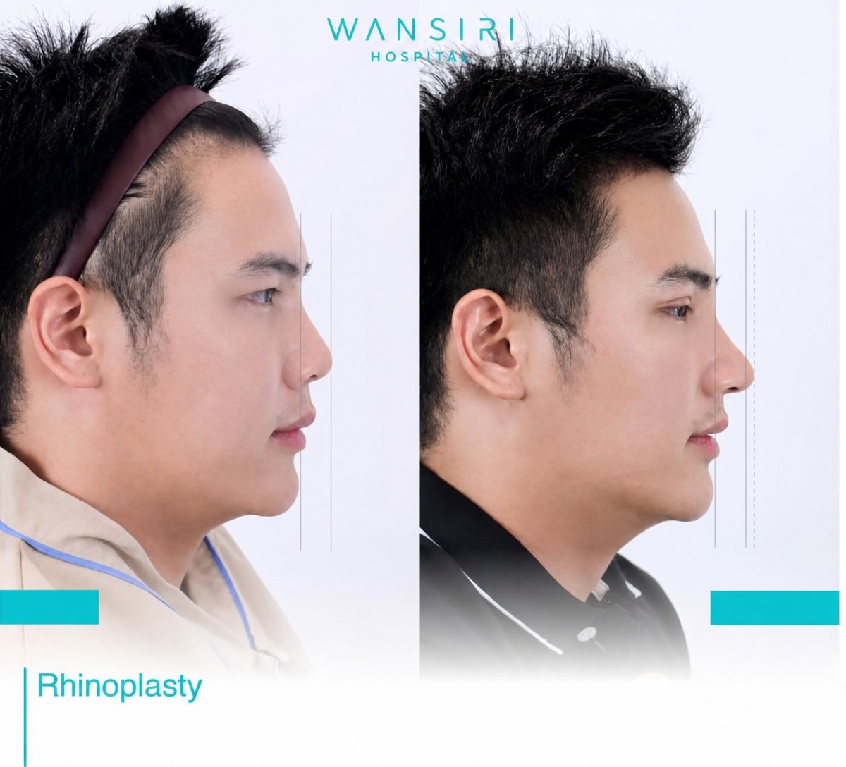 Before and after closed rhinoplasty results at Wansiri Hospital, improved nose profile