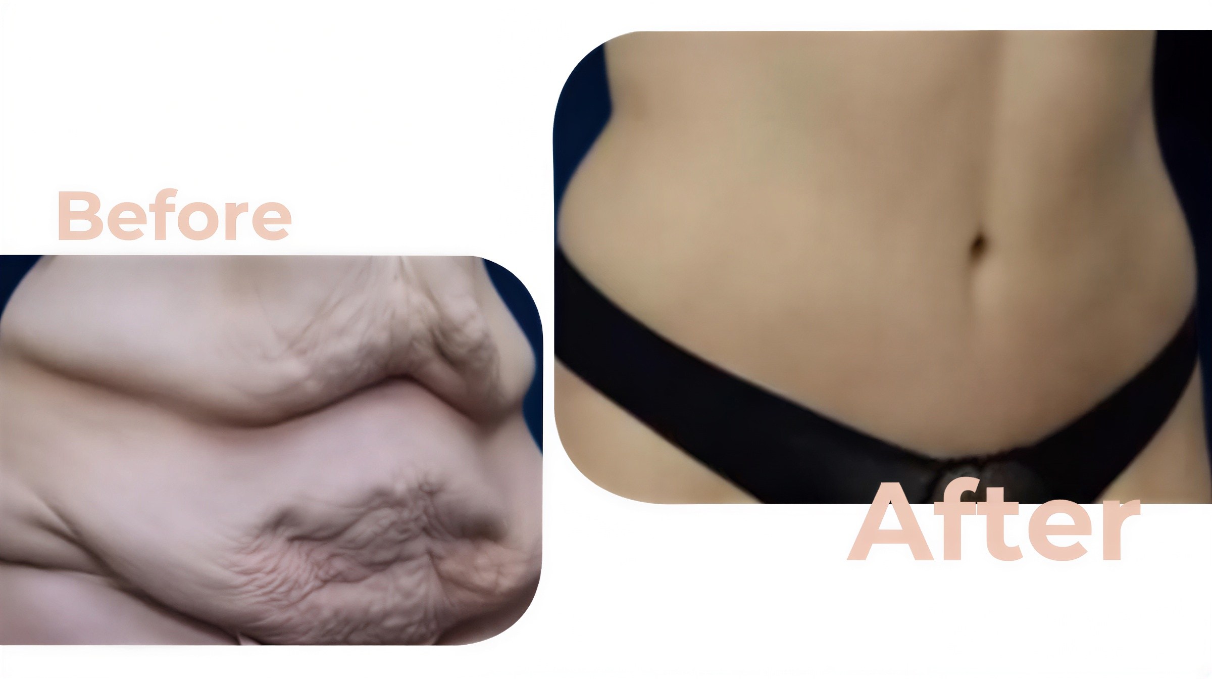 Resultados de abdominoplastia antes y después en Avicenna International Hospital, abdomen plano