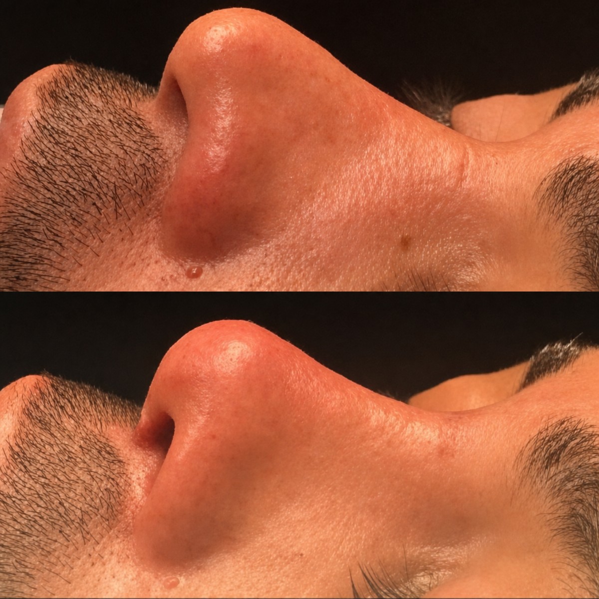 Before and after septoplasty results at Memorial Şişli Hospital, improved nasal profile