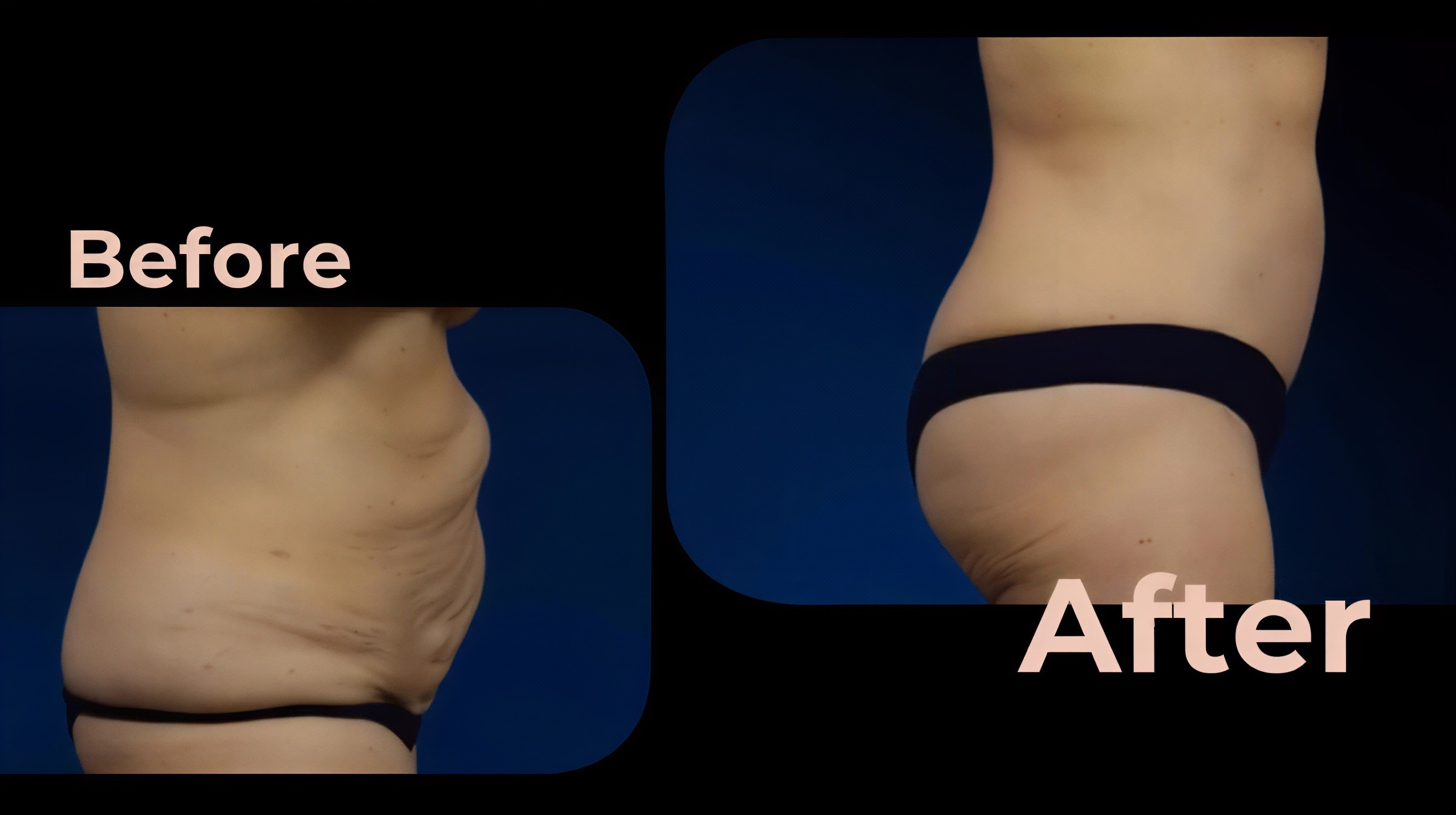 Resultados de abdominoplastia y liposucción antes y después en Avicenna International Hospital