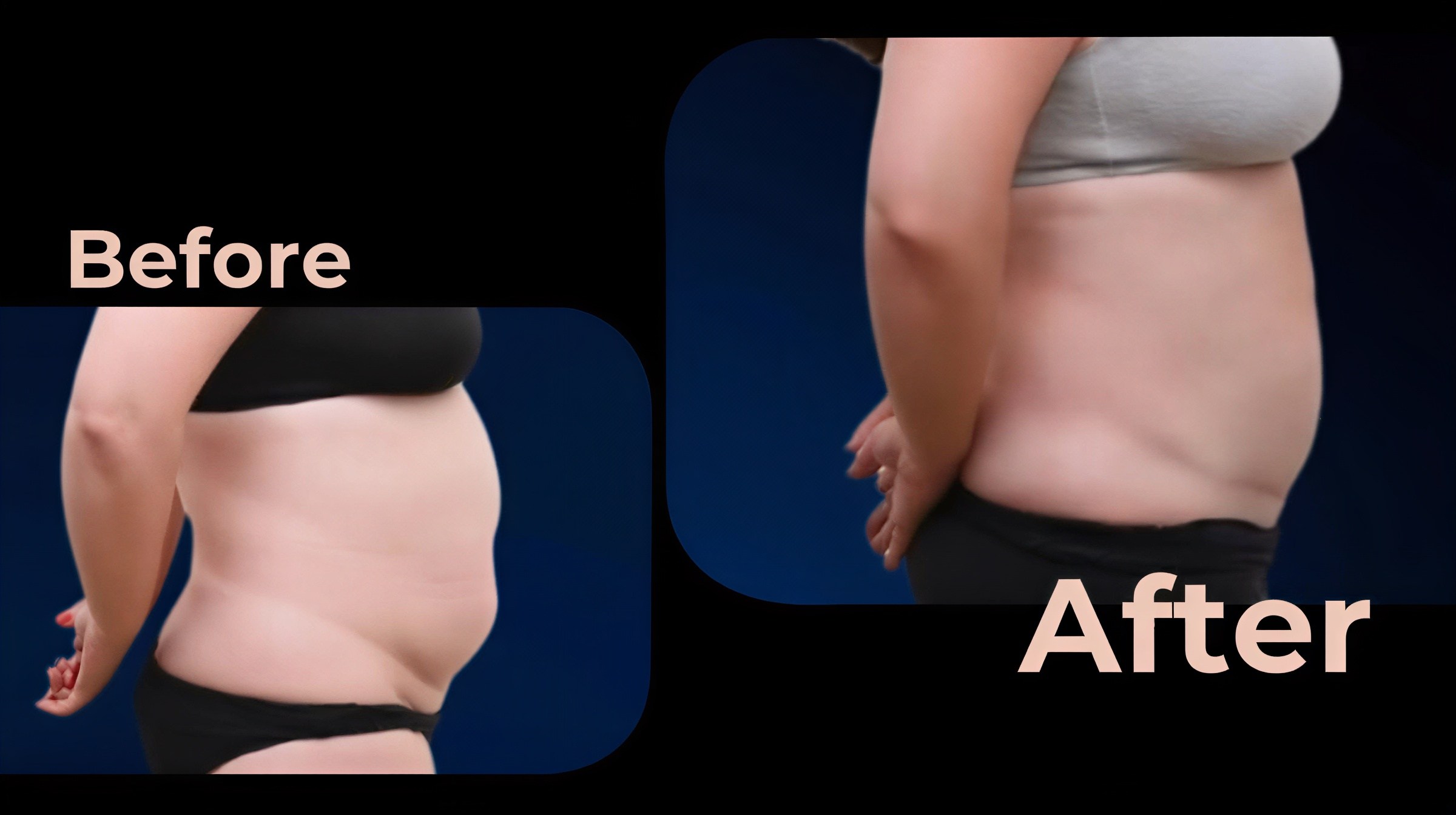 Resultados antes y después de abdominoplastia y liposucción en Avicenna International Hospital