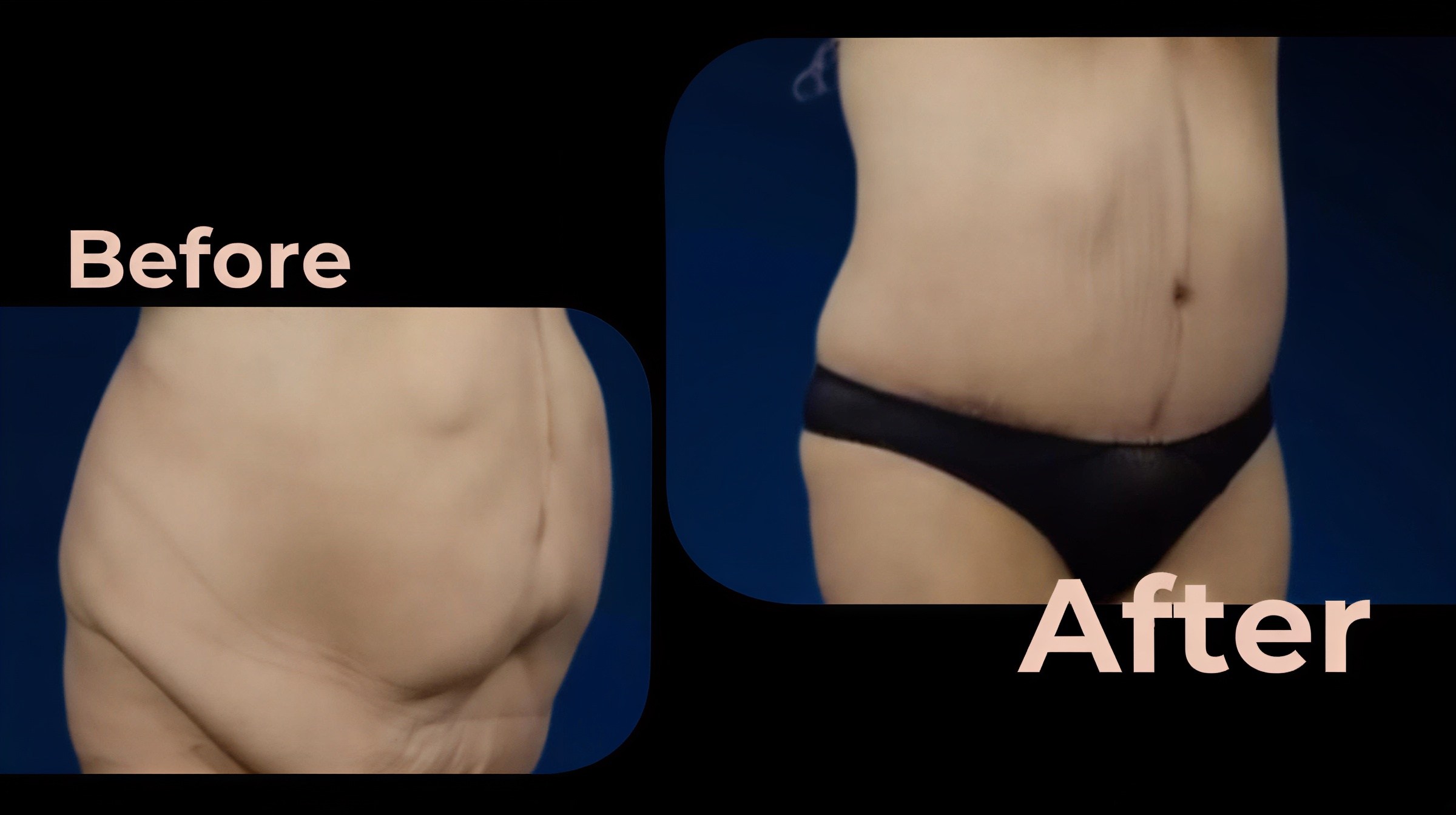 Resultados de abdominoplastia y liposucción antes y después en Avicenna International Hospital
