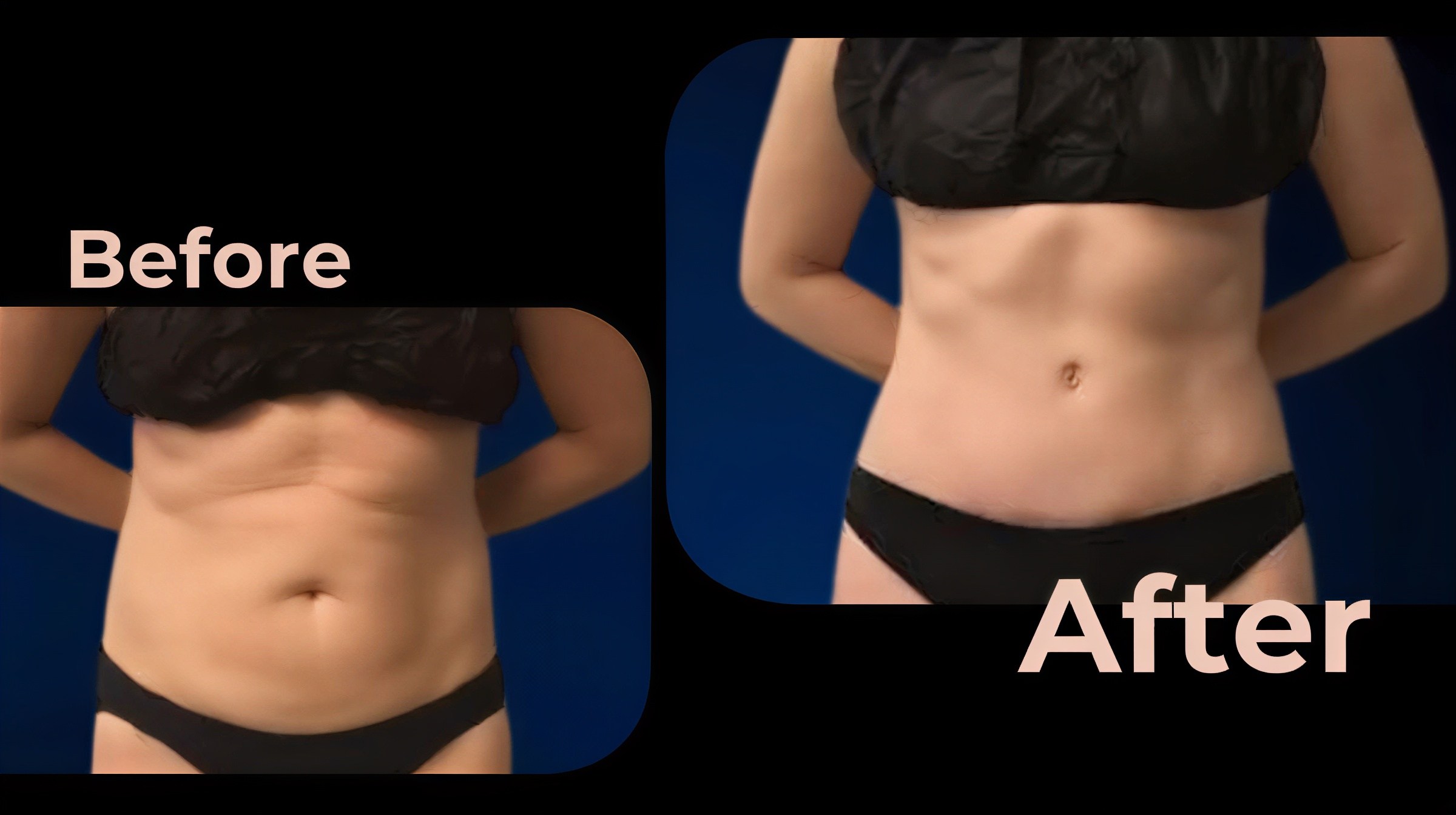 Resultados de abdominoplastia y liposucción antes y después en Avicenna International Hospital