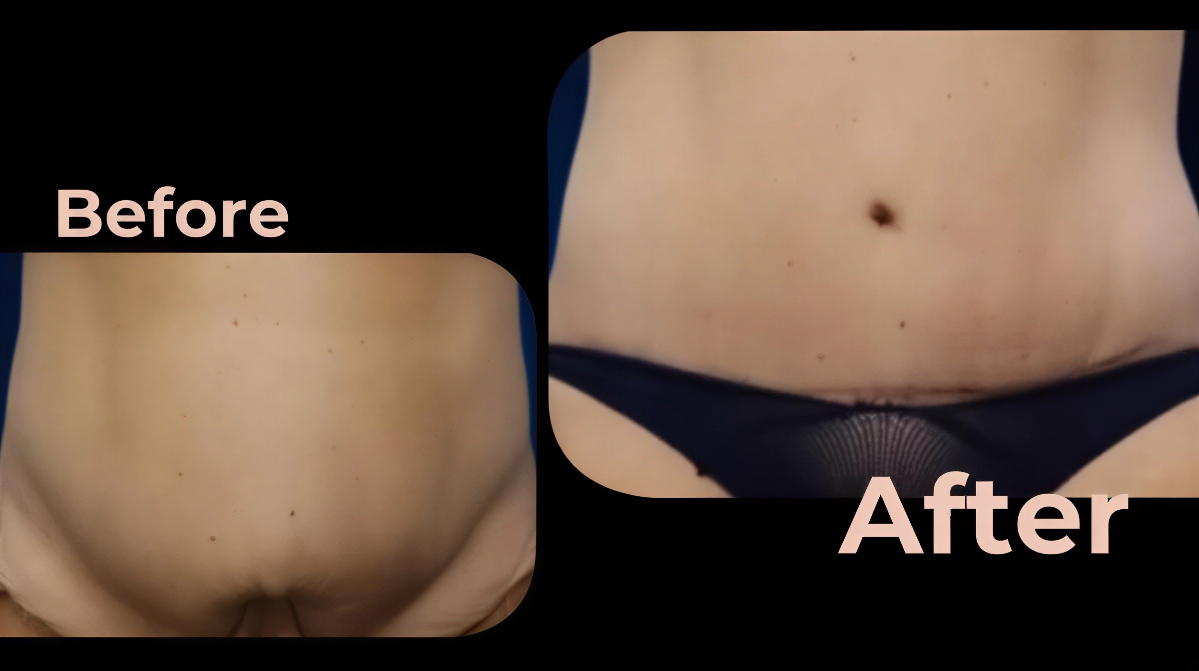 Resultados de abdominoplastia y liposucción antes y después en Avicenna International Hospital