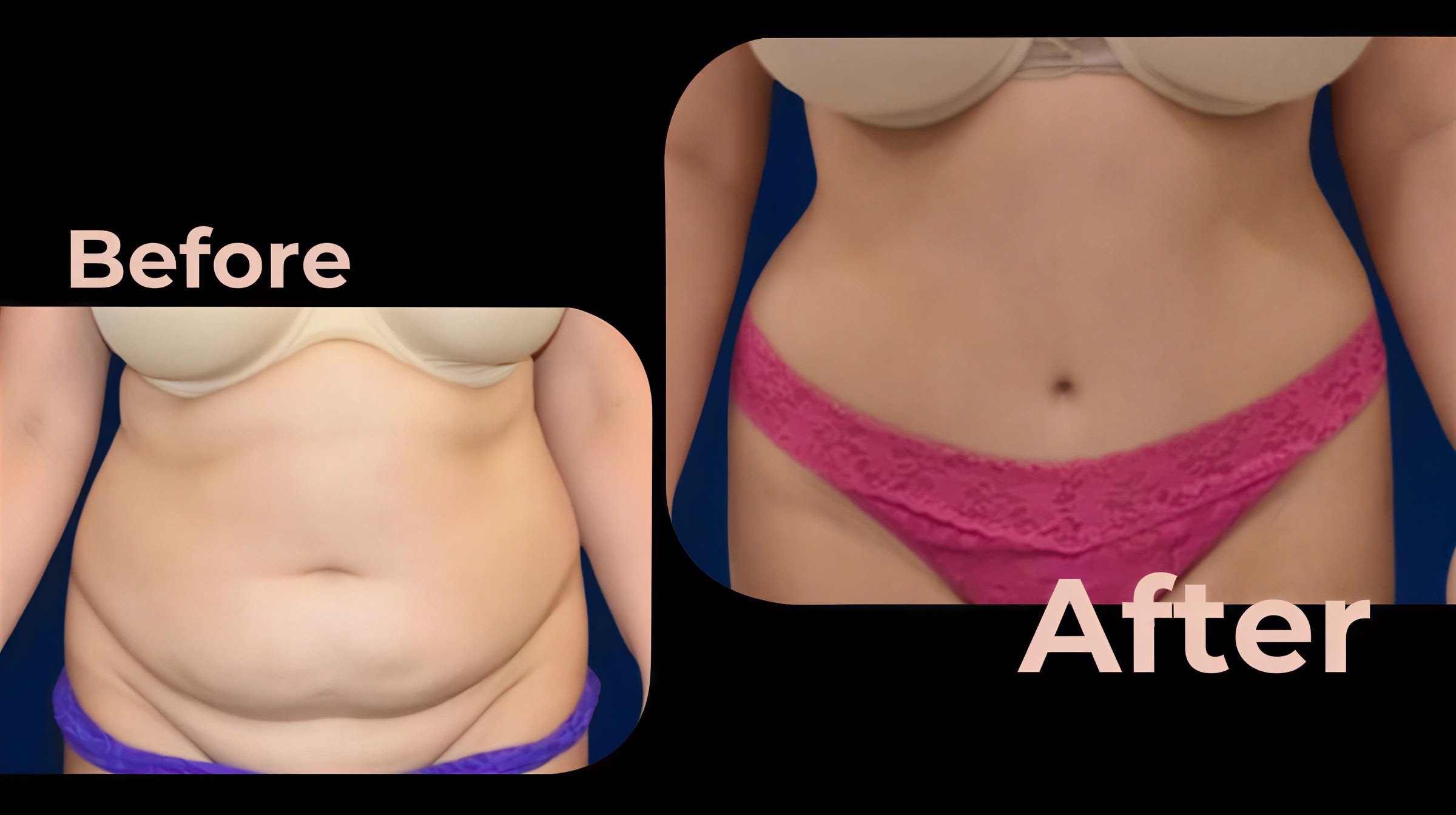 Resultados de abdominoplastia y liposucción antes y después en Avicenna International Hospital