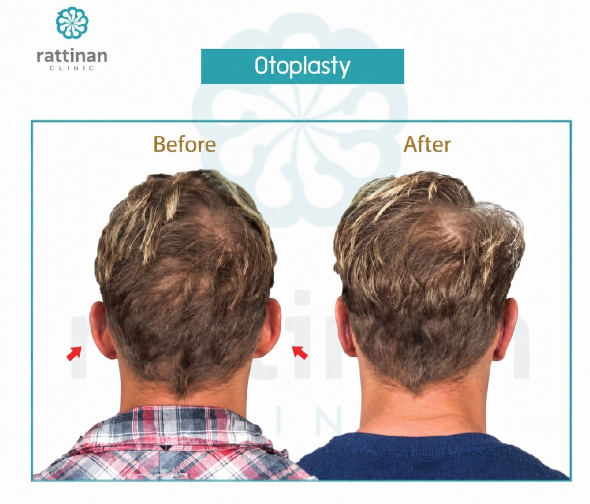 Before and after otoplasty results at Rattinan Clinic, ear reshaping for improved appearance