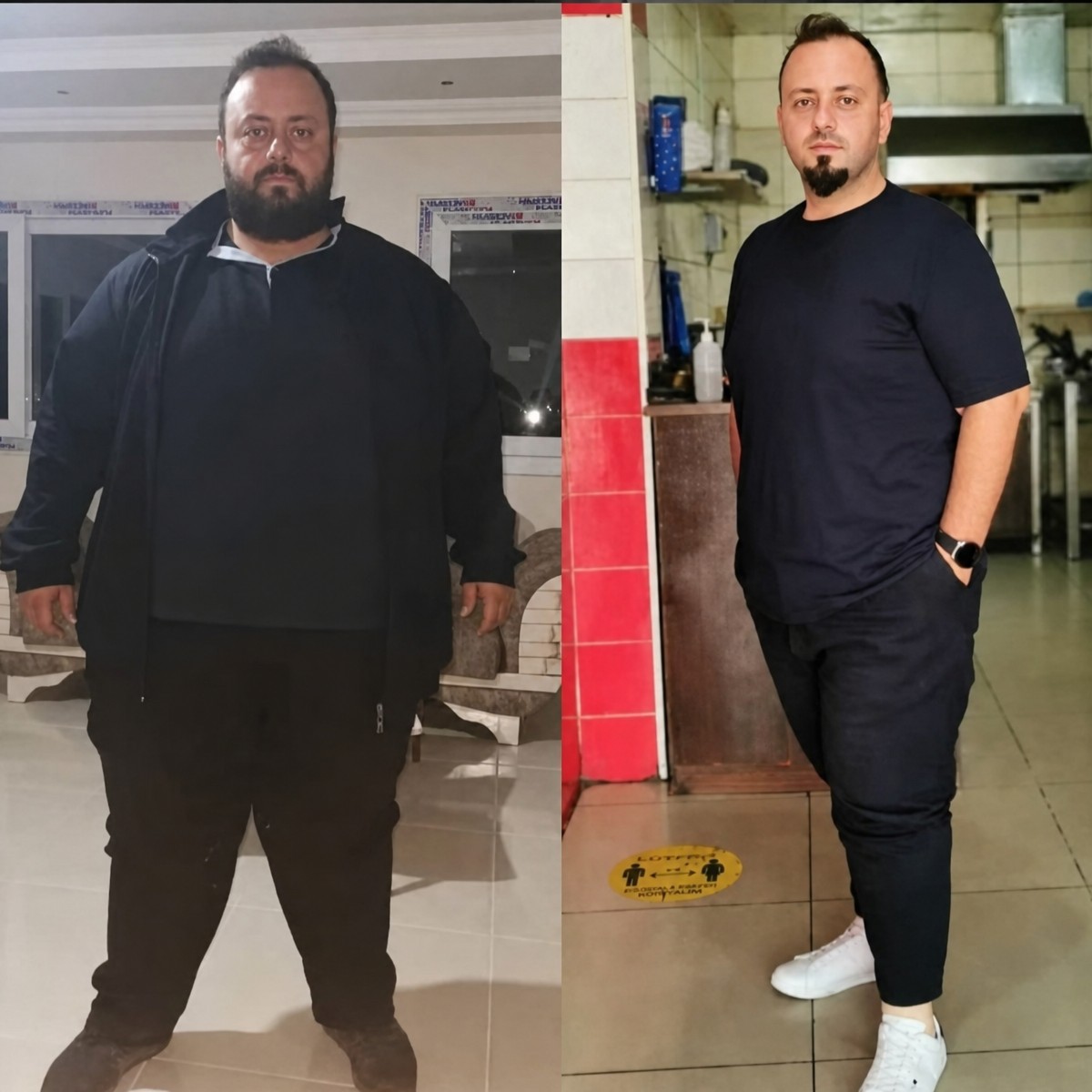 نتائج قبل وبعد تكميم المعدة في عيادة Professor Dr. Samet Yardımcı