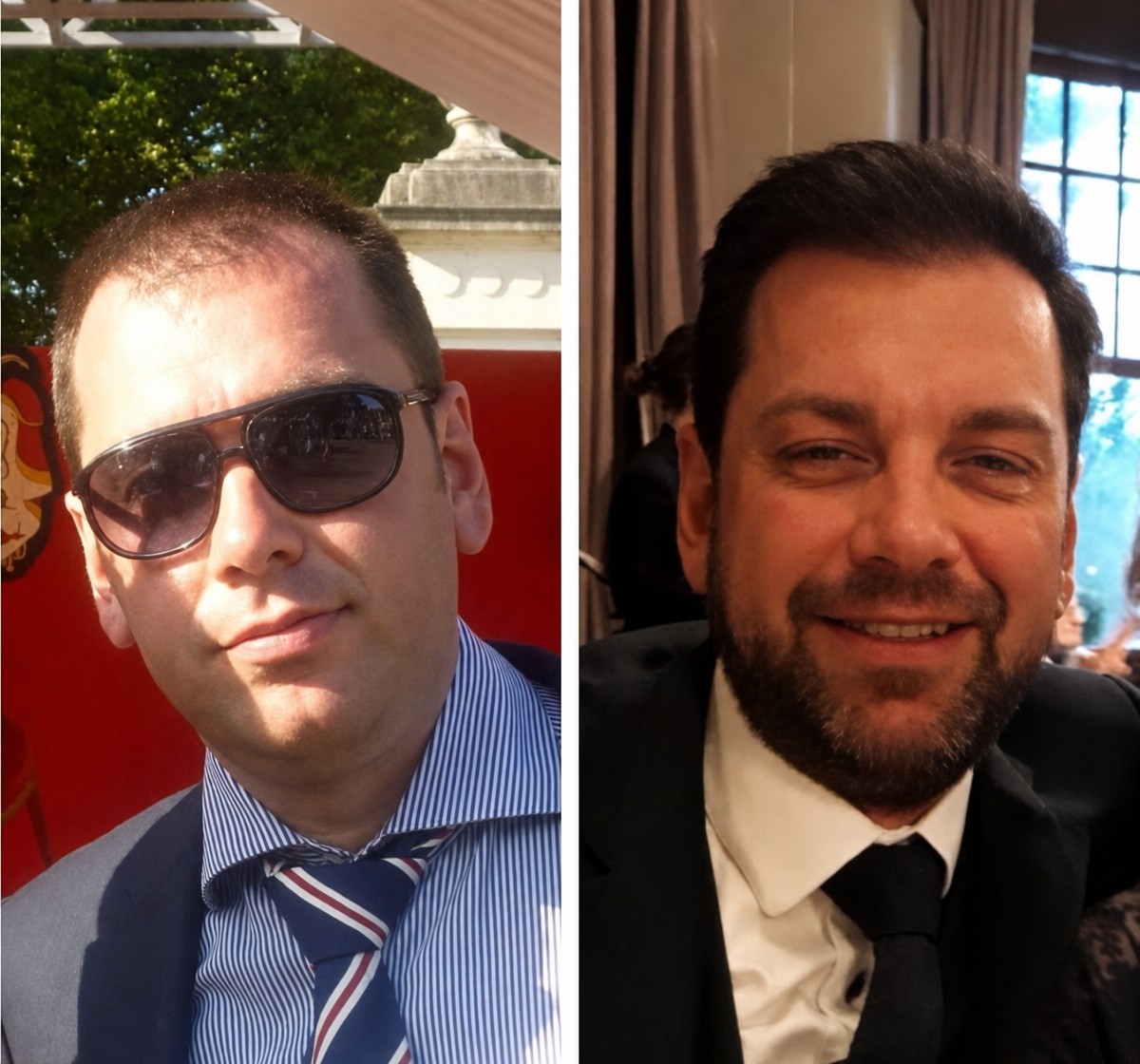 Before and after DHI hair transplant results at Istanbul Aesthetic Plastic Surgery Center