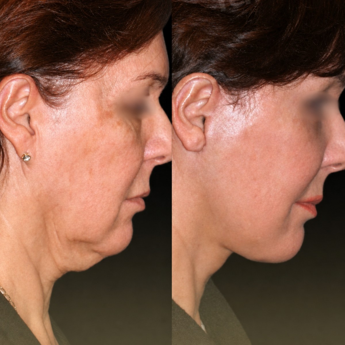 Facelift Vorher-Nachher-Ergebnis im Memorial Bahçelievler Hospital, sichtbare Kieferlinie