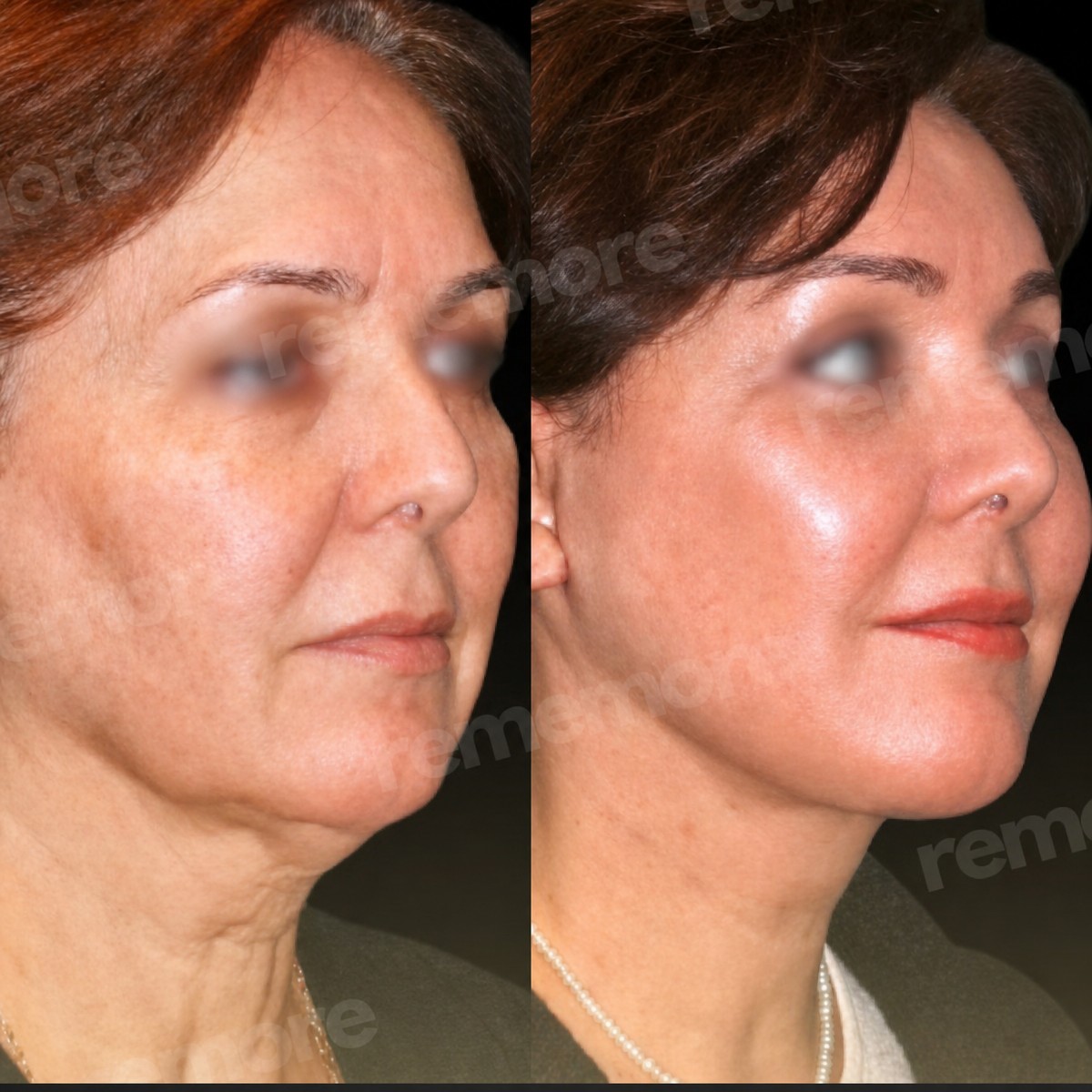 Facelift before and after results at Memorial Bahçelievler Hospital, visible facial rejuvenation