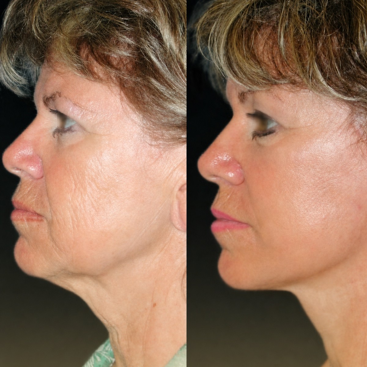 Facelift before and after results at Memorial Bahçelievler Hospital, visible facial rejuvenation
