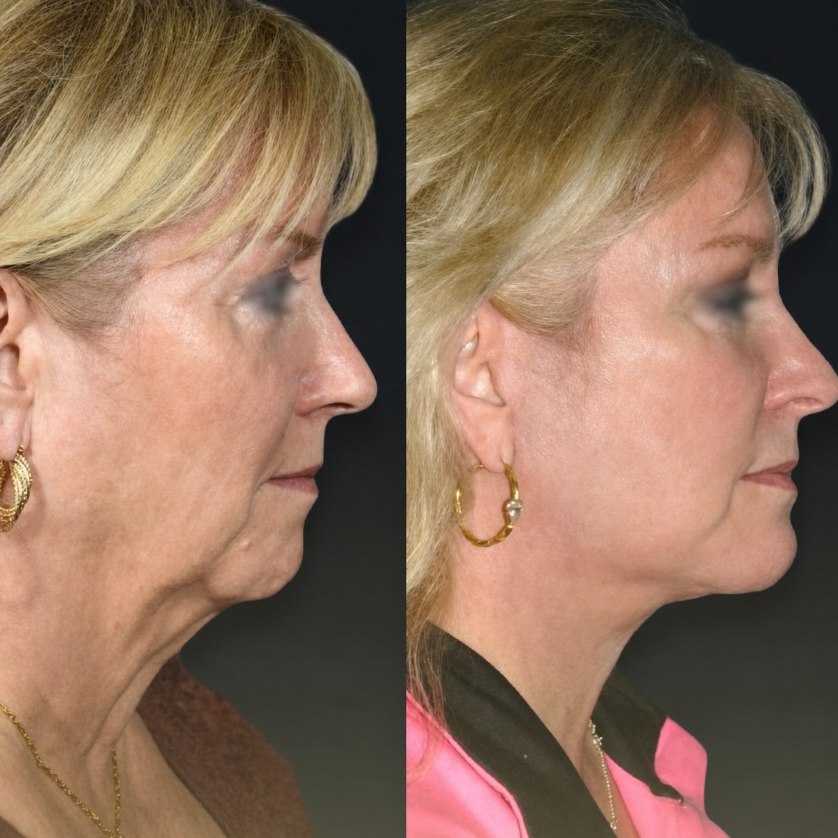 Facelift Vorher-Nachher-Ergebnisse im Memorial Bahçelievler Hospital, sichtbare Verjüngung