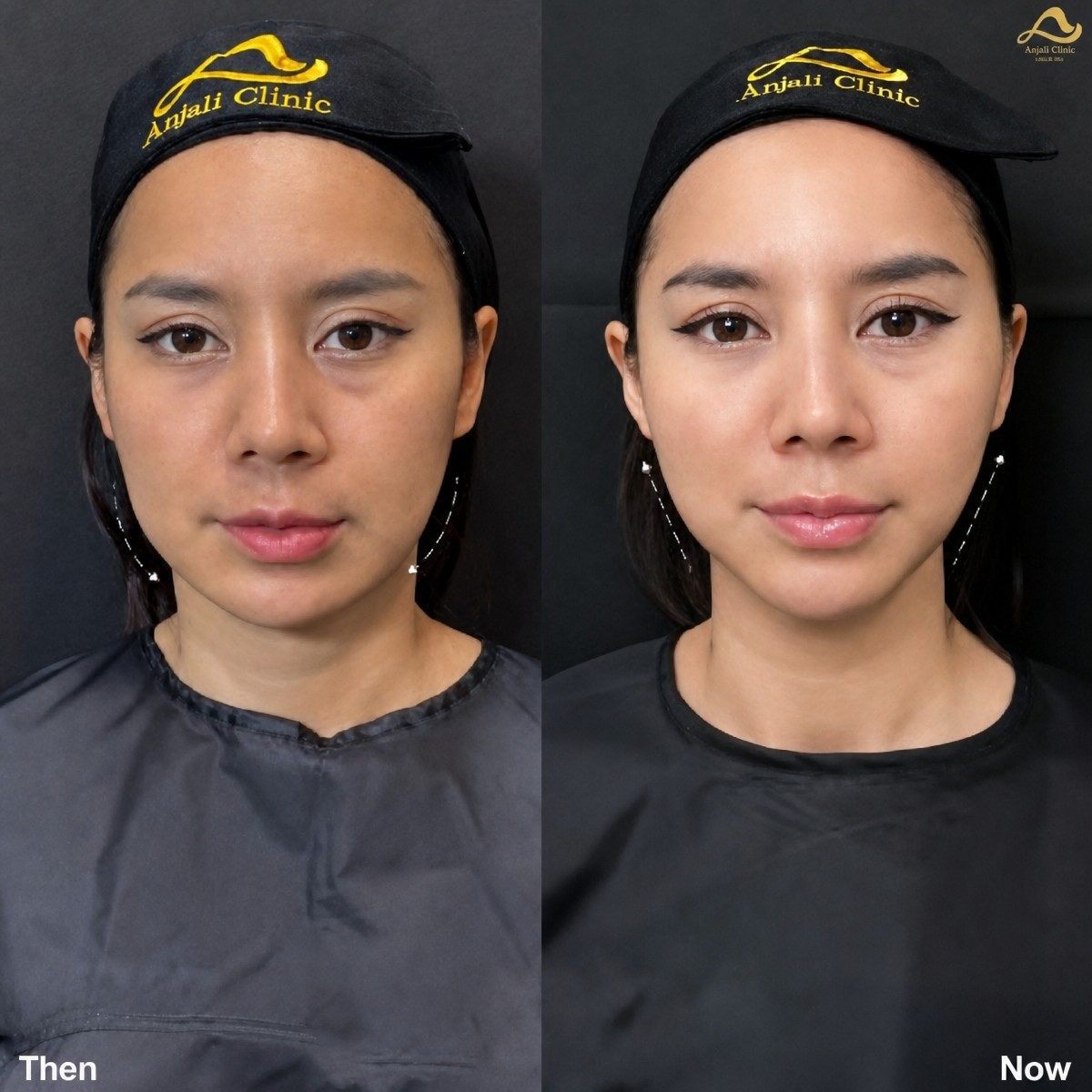 Before and after collagen lifting results at Anjali Clinic – visible facial skin tightening