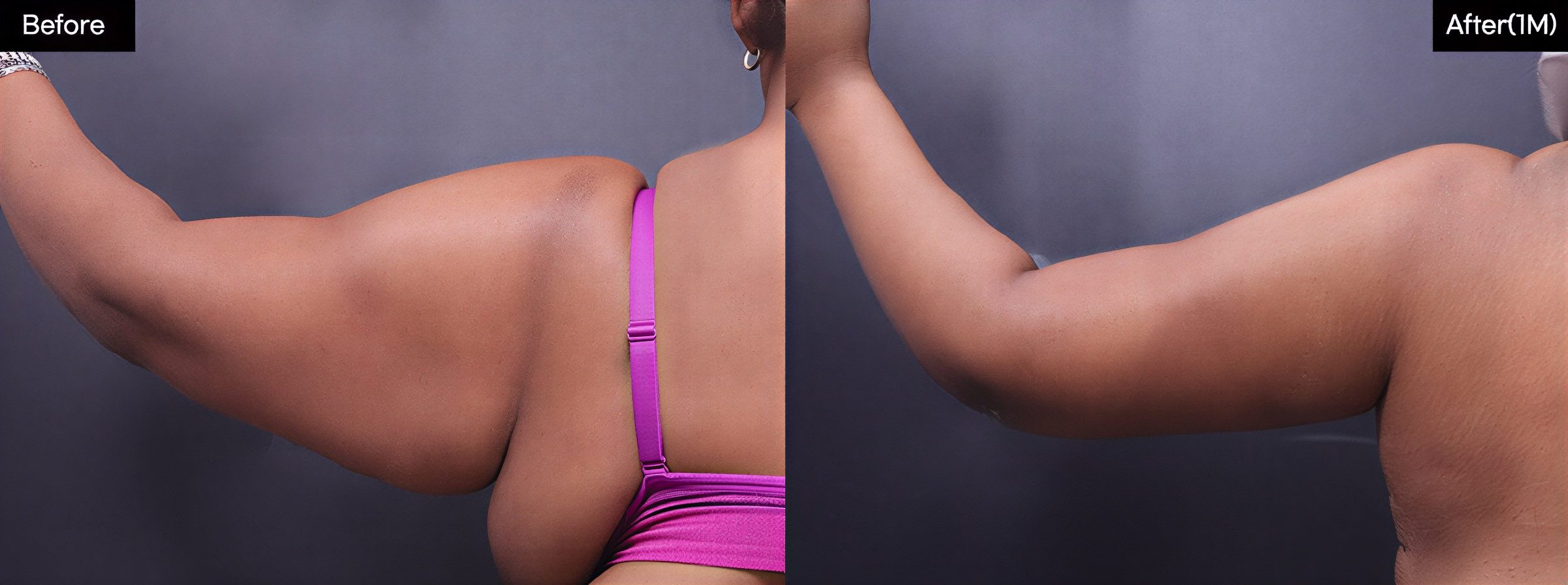نتائج شفط الدهون بالفيزر للذراعين قبل وبعد في VG Plastic Surgery وتحسن الشكل