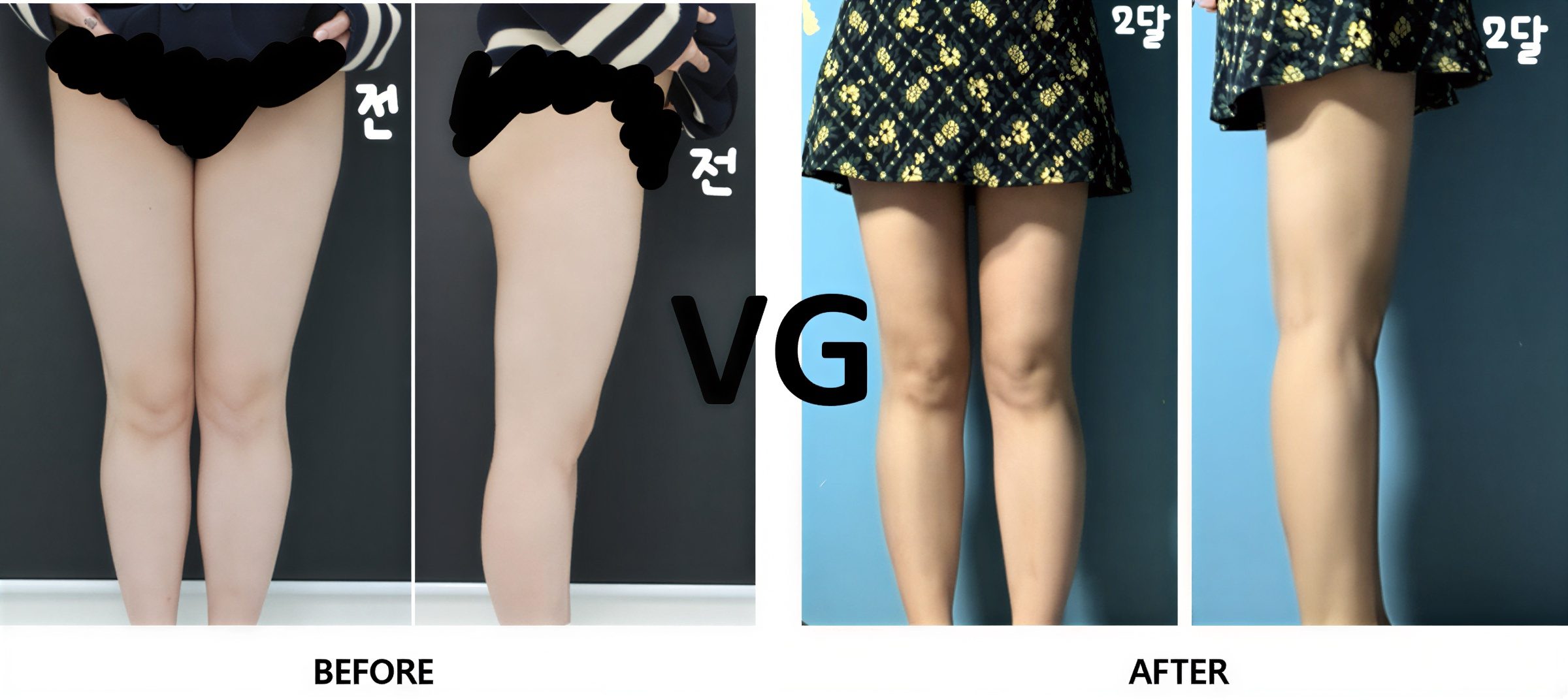 نتائج شفط الدهون فايزر قبل وبعد في VG Plastic Surgery، أفخاذ وسيقان أنحف