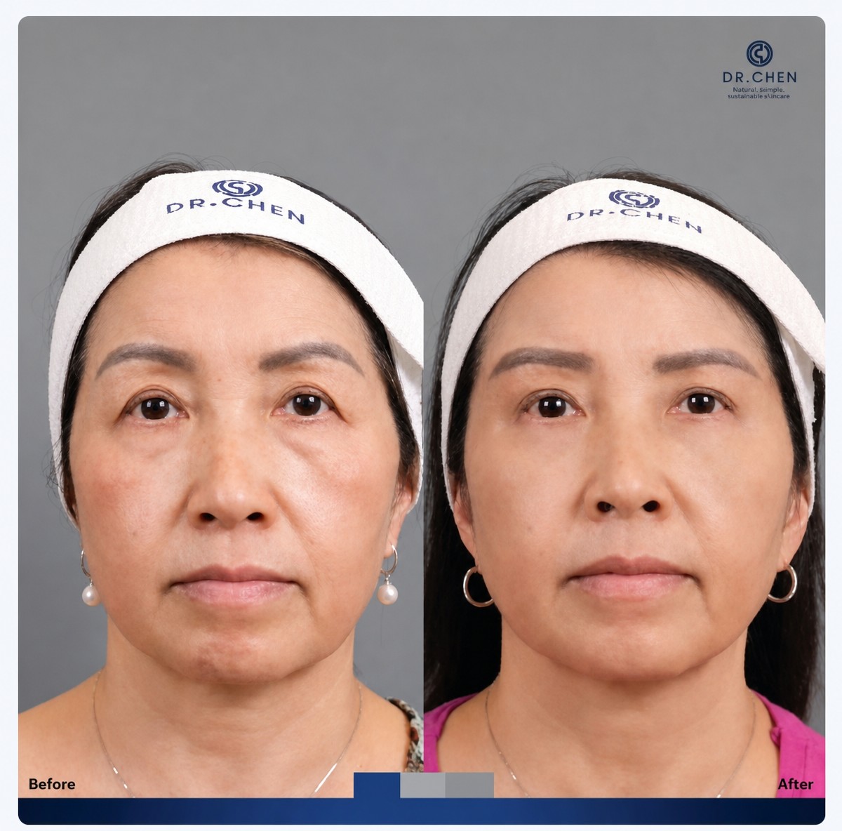 Результаты блефаропластики нижних век до и после в Dr. Chen Surgery Hospital International Center