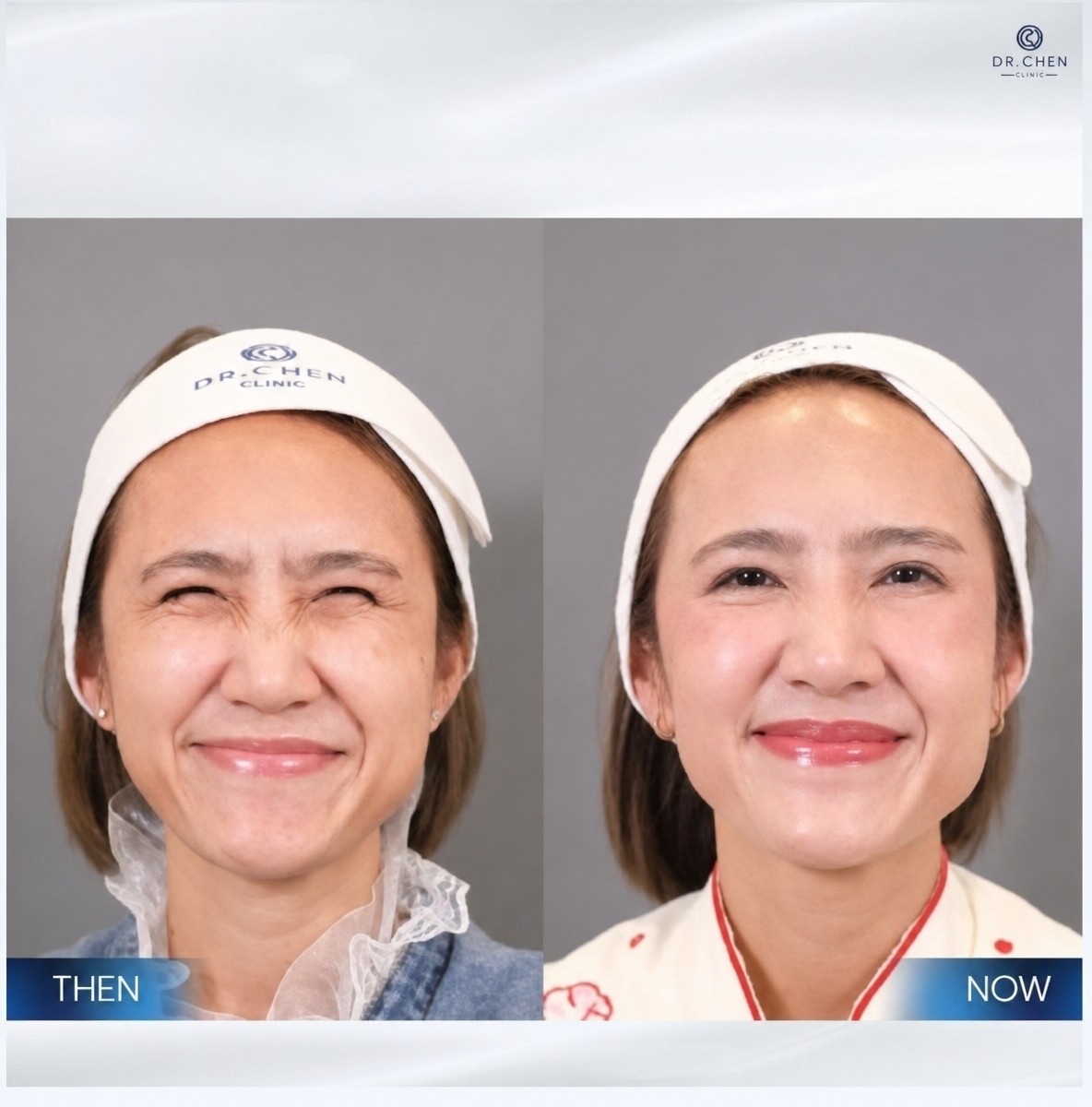 Before and after Botox injections at Dr. Chen Clinic, reduced facial wrinkles result