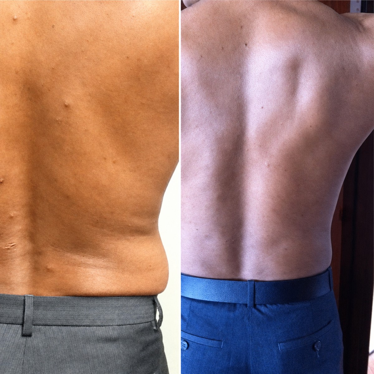 نتائج شفط الدهون قبل وبعد في عيادة Dr. Arturo Muñoz Meza Plastic Surgery، تحديد الظهر