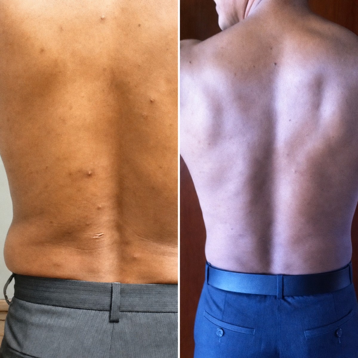 نتائج شفط الدهون قبل وبعد في عيادة Dr. Arturo Muñoz Meza Plastic Surgery، تحسين شكل الظهر