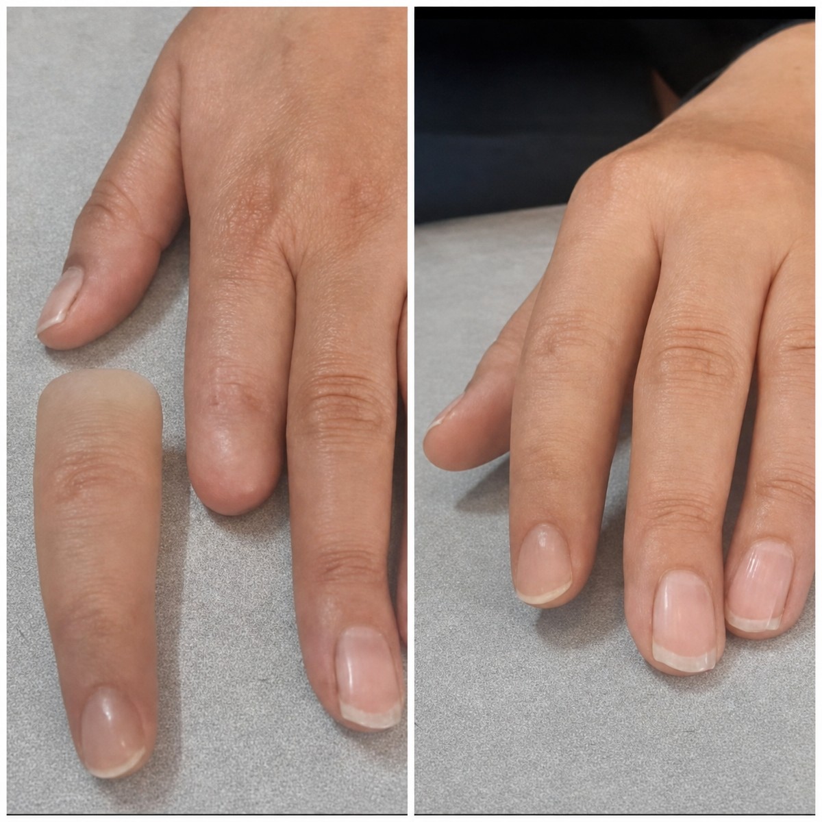 Before and after prosthetic finger results at Luxmed Protez Clinic, natural hand restoration