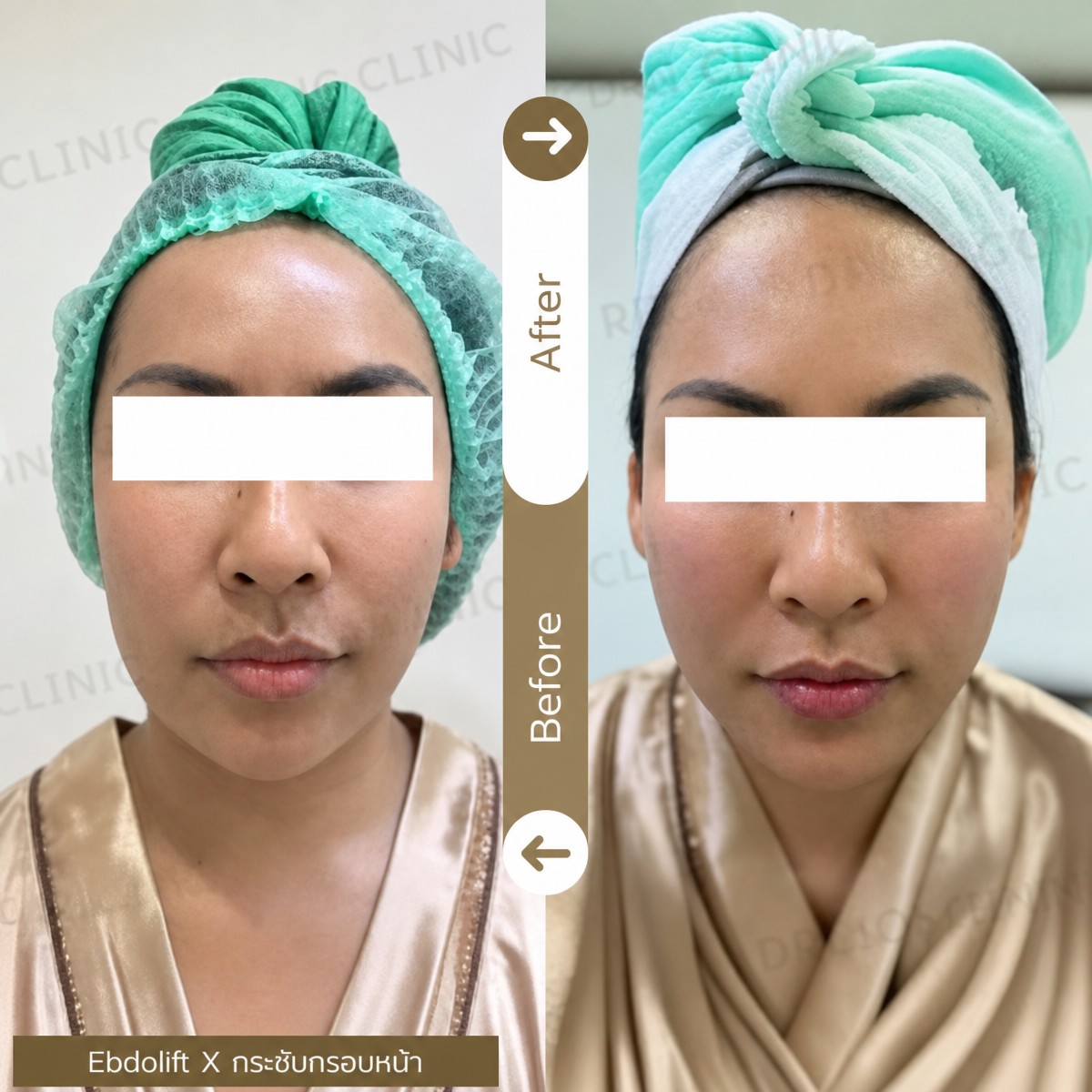 Resultados de lifting con hilos antes y después en Doctor Aomthong Clinic - Center For Women, contorno facial
