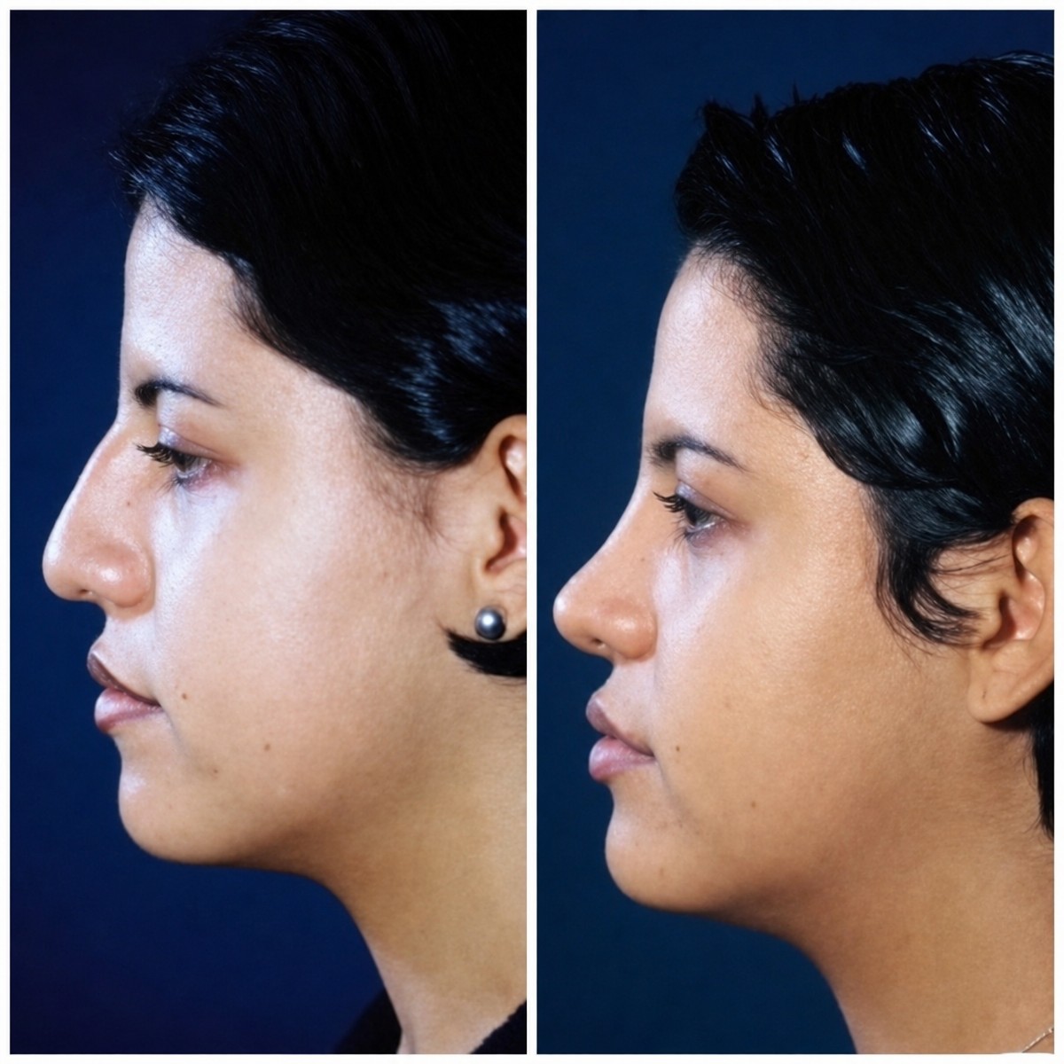 Resultados de rinoplastia antes y después en Dr. Arturo Muñoz Meza Plastic Surgery, remodelación nasal
