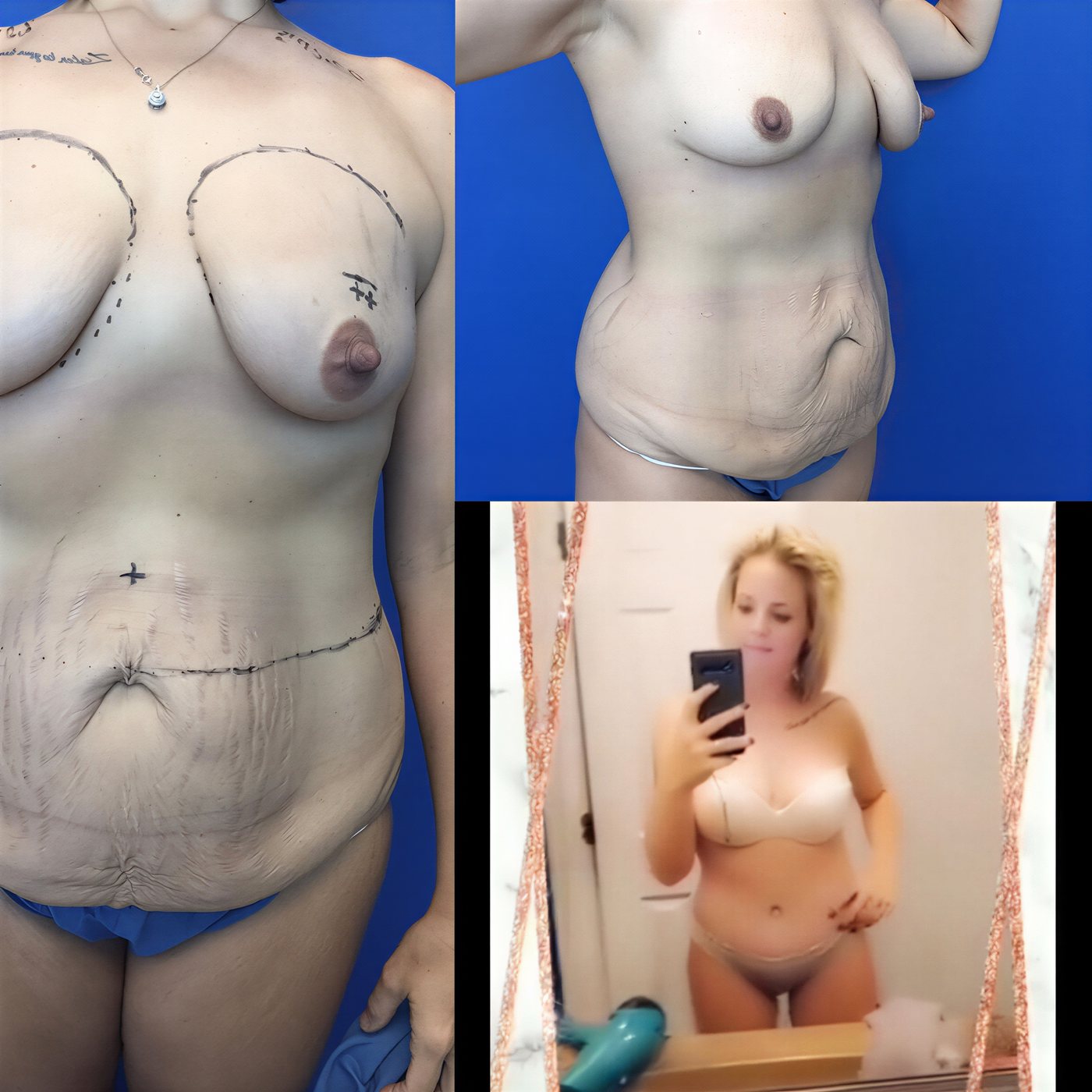 Resultados antes y después de mommy makeover en Dr. Arturo Muñoz Meza Plastic Surgery, contorno corporal