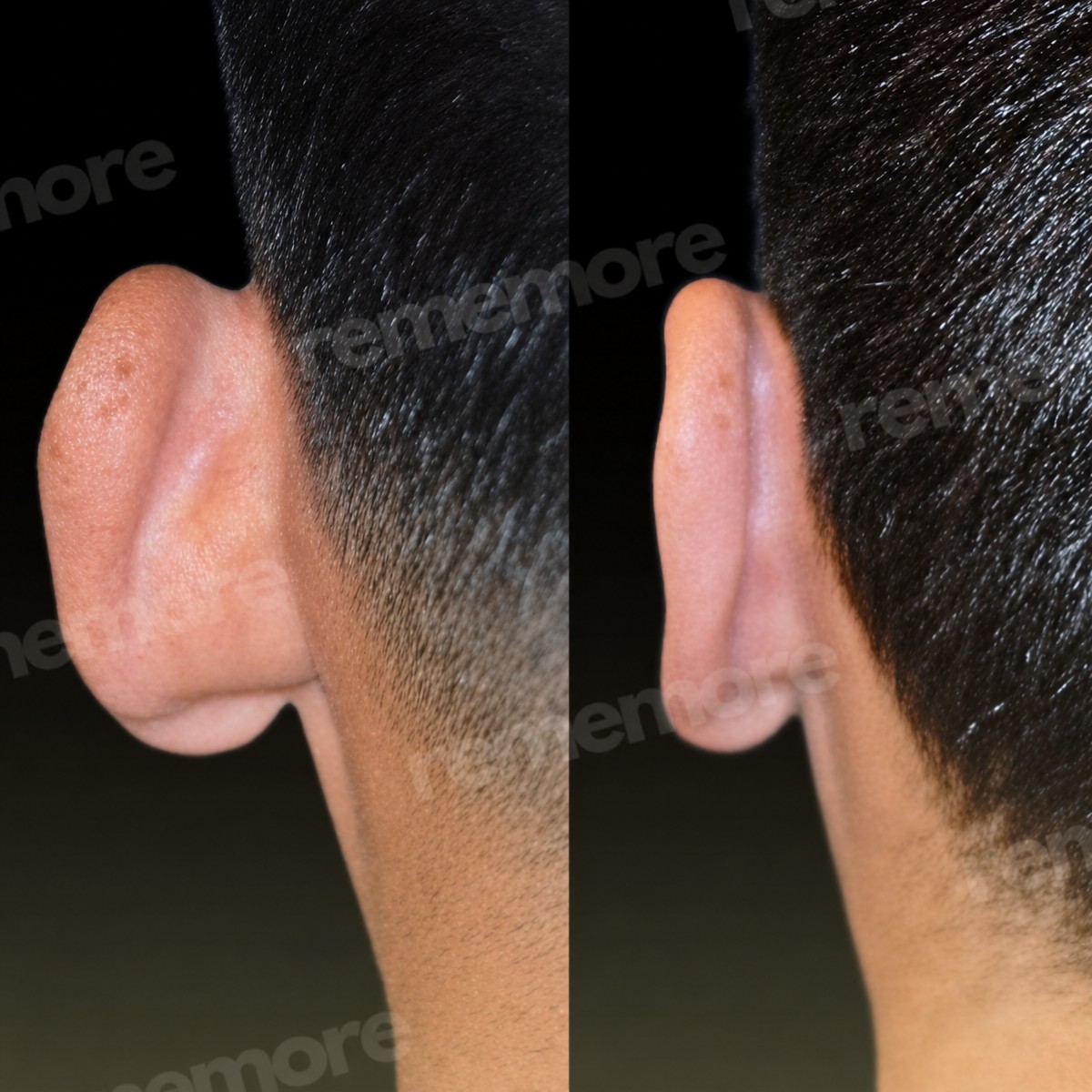 Résultats avant et après otoplastie à Memorial Antalya Hospital, correction des oreilles