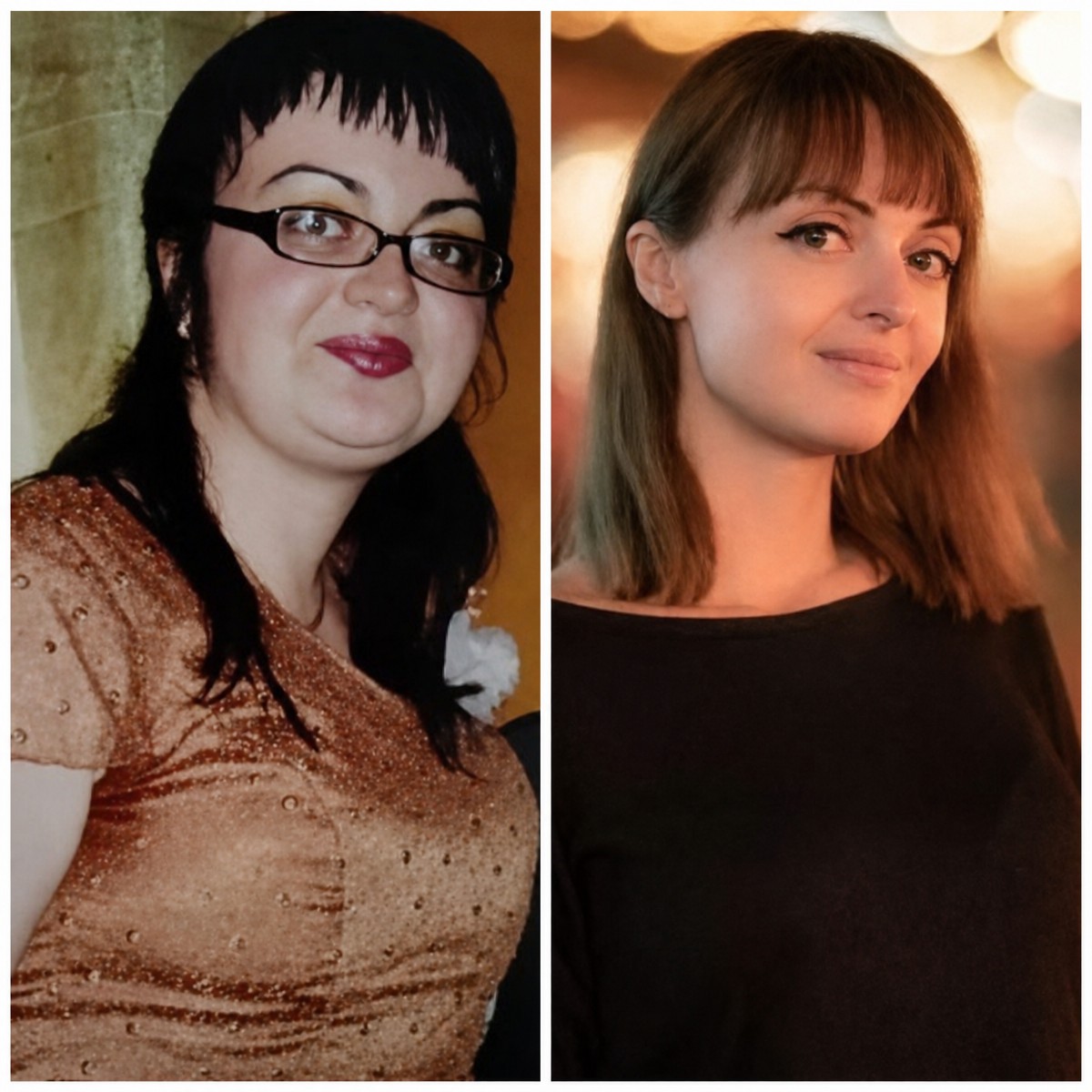 Before and after gastric bypass results at Ponderas Academic Hospital, significant weight loss