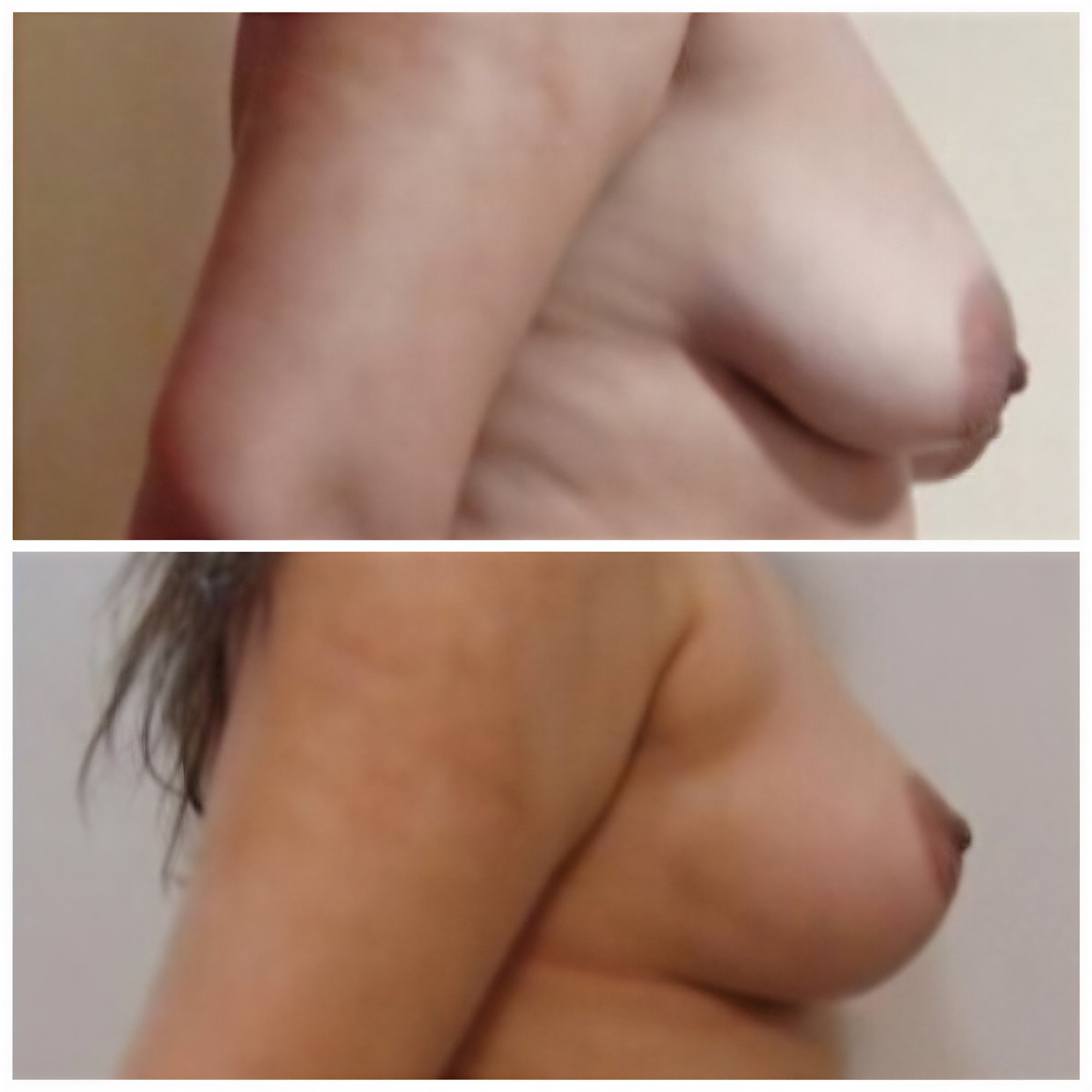 Resultados antes y después de lifting de senos en Istanbul Aesthetic Plastic Surgery Center, mejor contorno