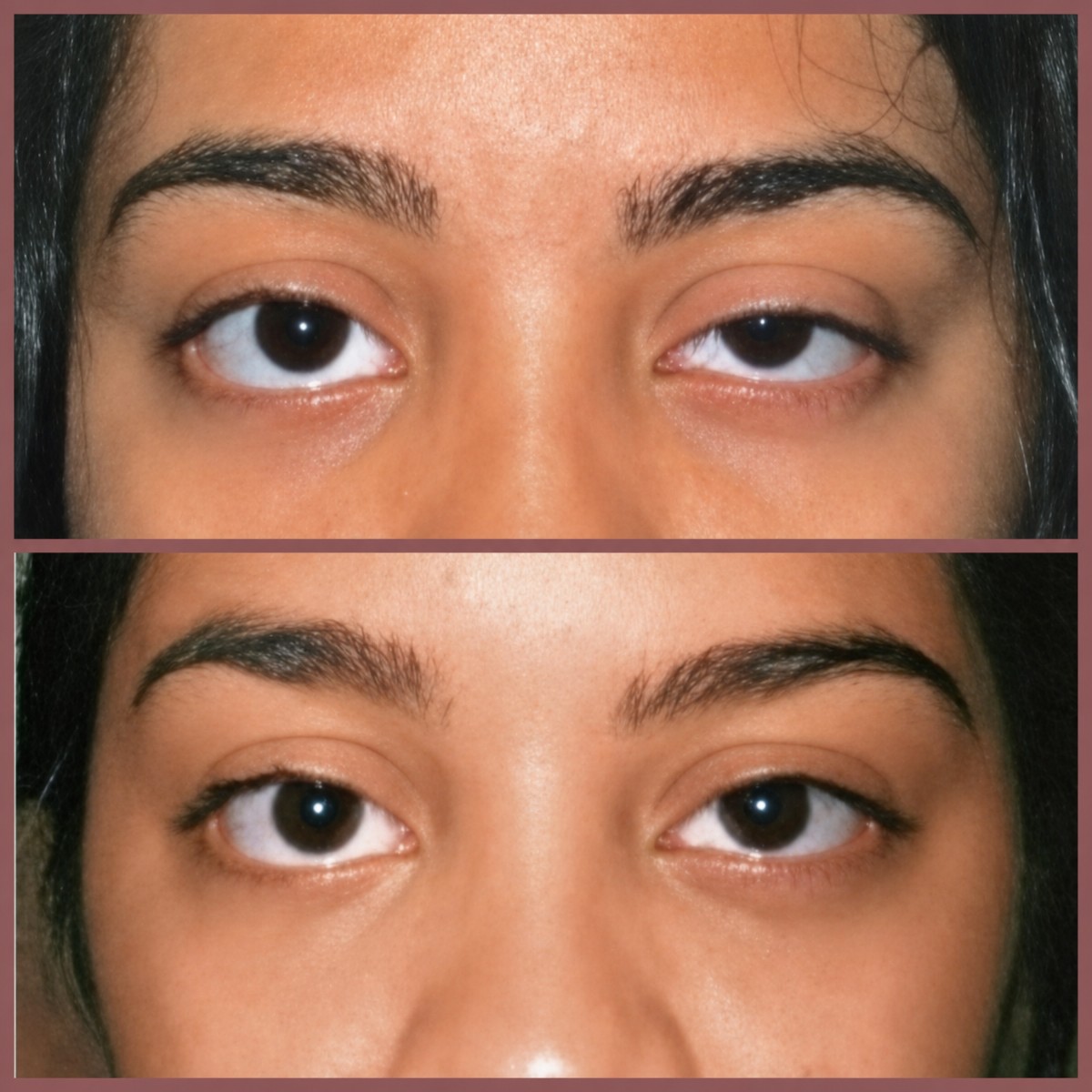 Before and after blepharoplasty results at ID Clinic Bangkok, eyelid correction improvement