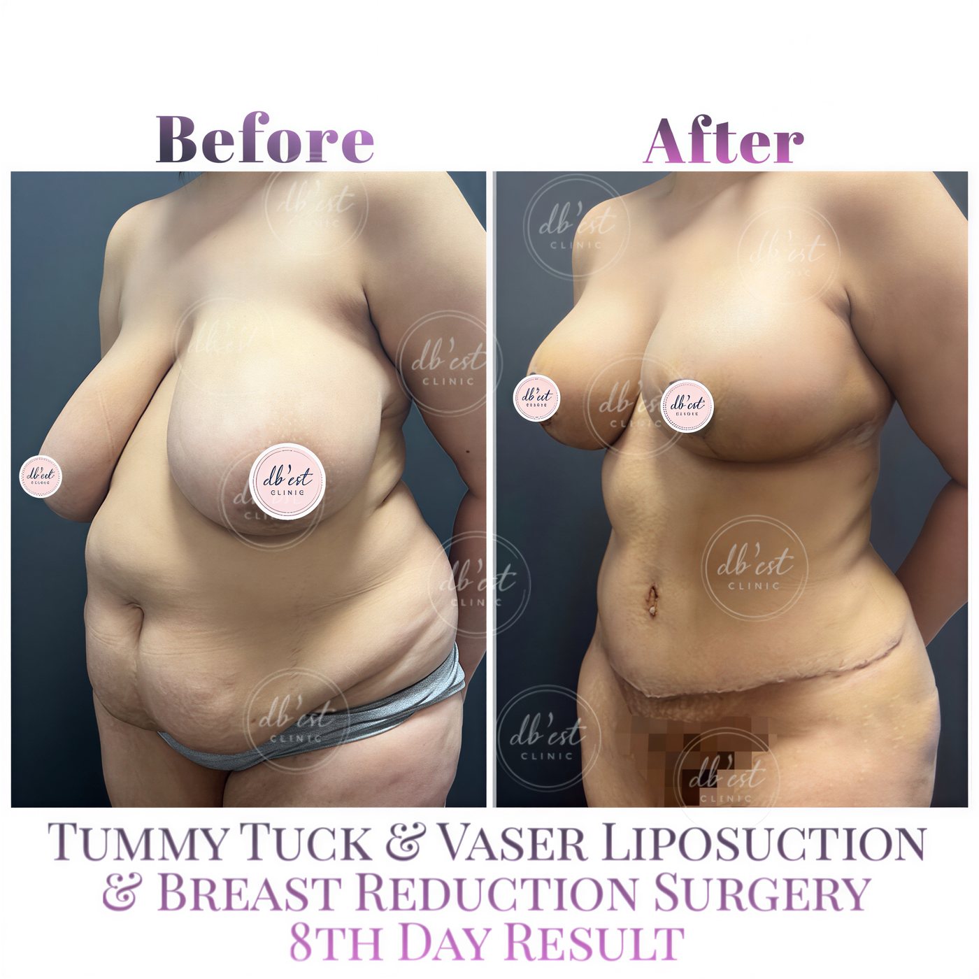 Mommy makeover antes y después en Db'est Clinic: abdominoplastia, Vaser lipo, reducción mamaria
