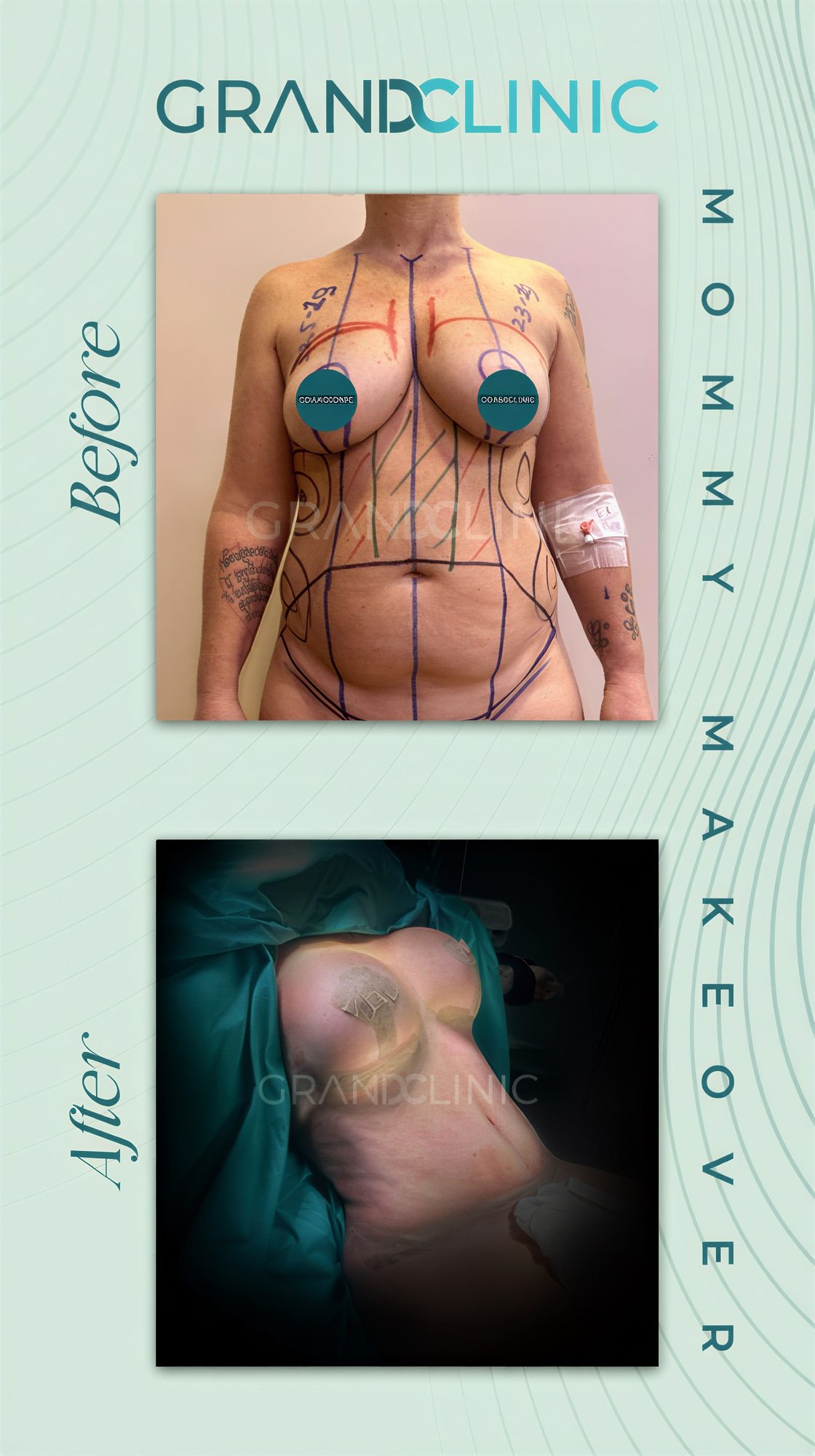 Resultados antes y después de mommy makeover en Grand Clinic – contorno corporal y elevación mamaria