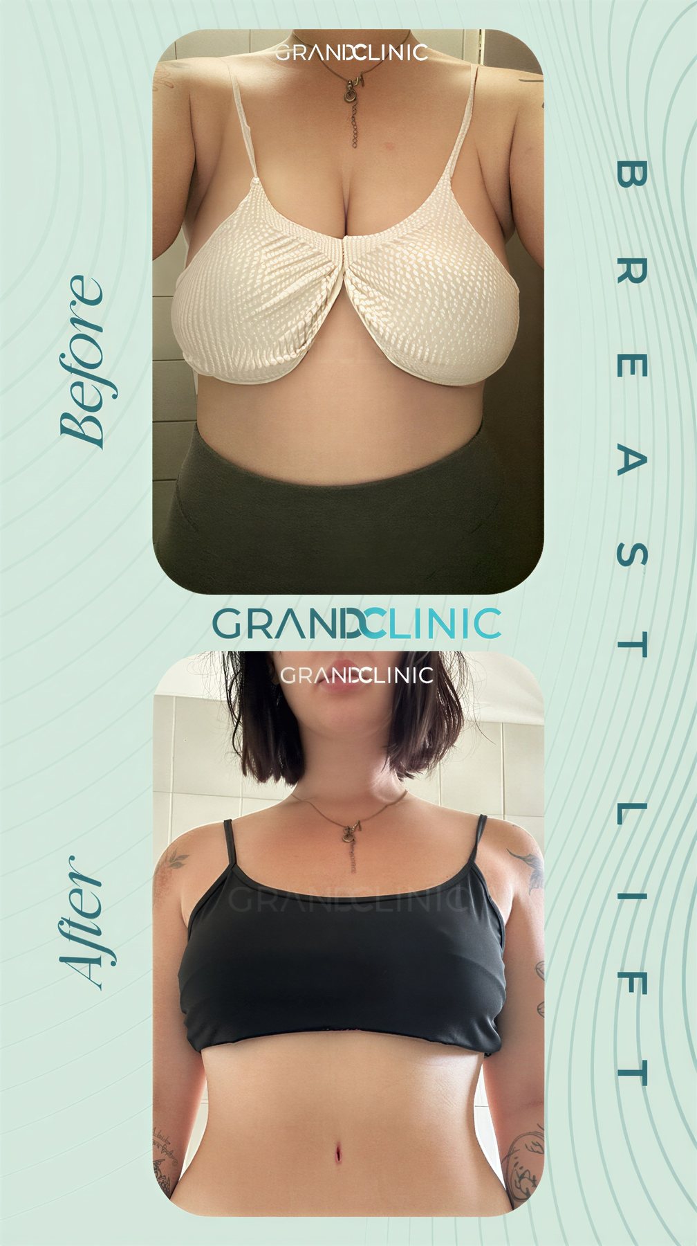 Resultados de lifting de senos antes y después en Grand Clinic – mejor forma y contorno