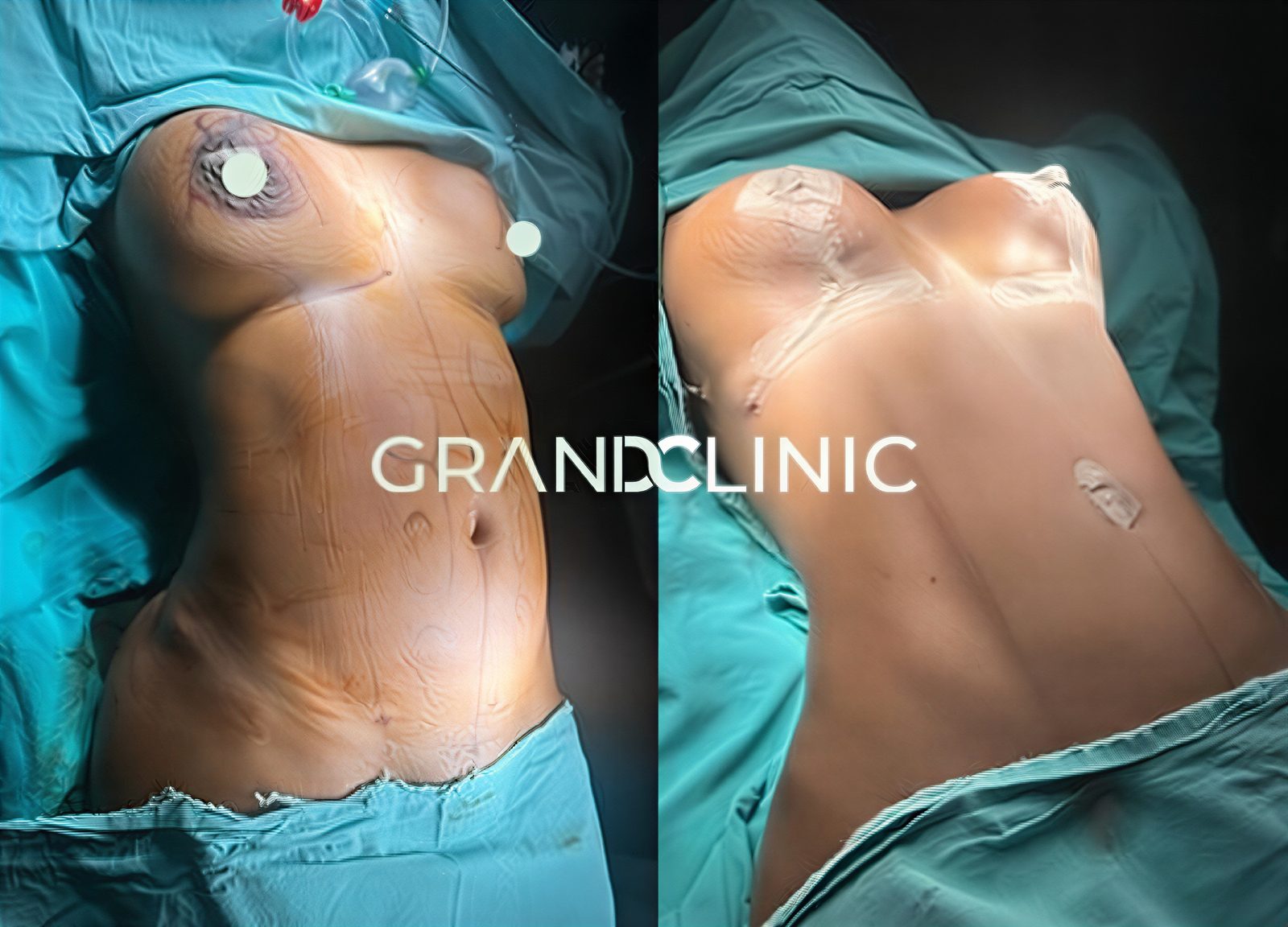 Resultados de mamoplastia antes y después en Grand Clinic, mejora visible del busto y contorno