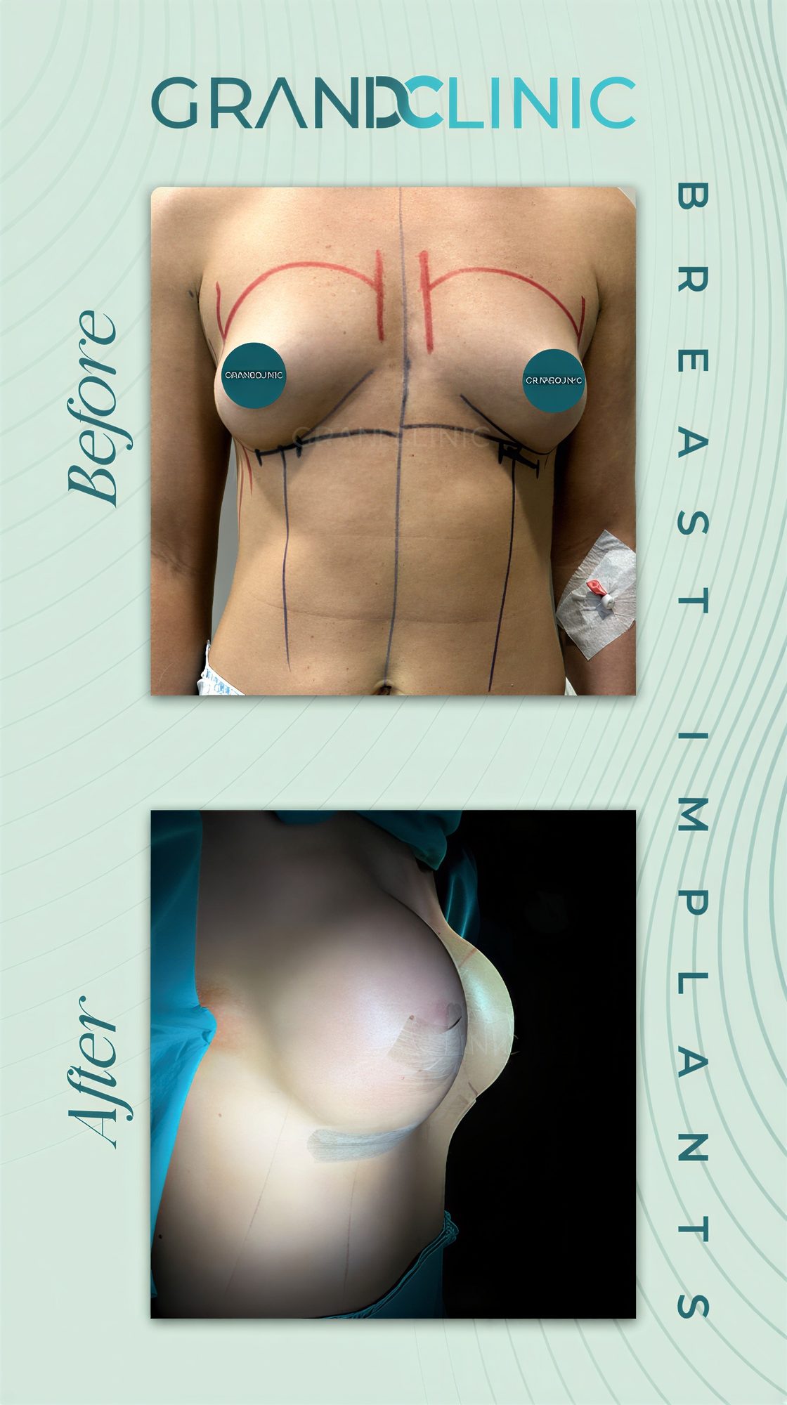 Antes y después de implantes mamarios en Grand Clinic: resultado visible de mamoplastia