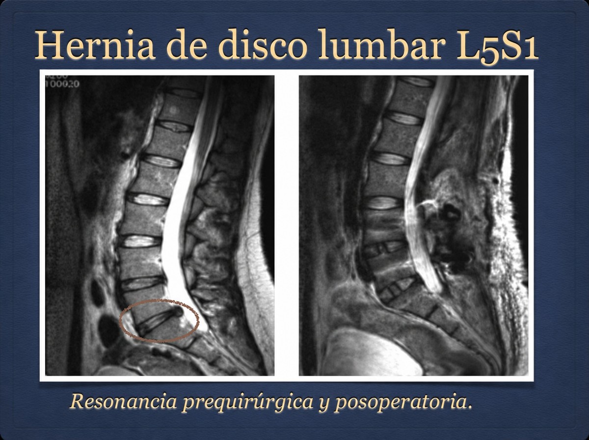نتائج قبل وبعد استئصال القرص القطني في GDL High Specialty Neurosurgery