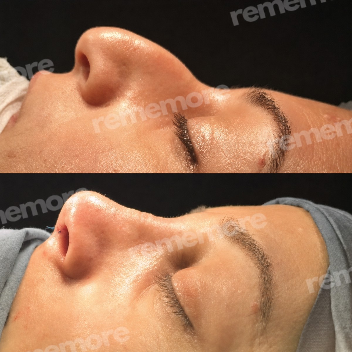 Before and after Asian rhinoplasty results at Memorial Şişli Hospital, nose reshaping outcome