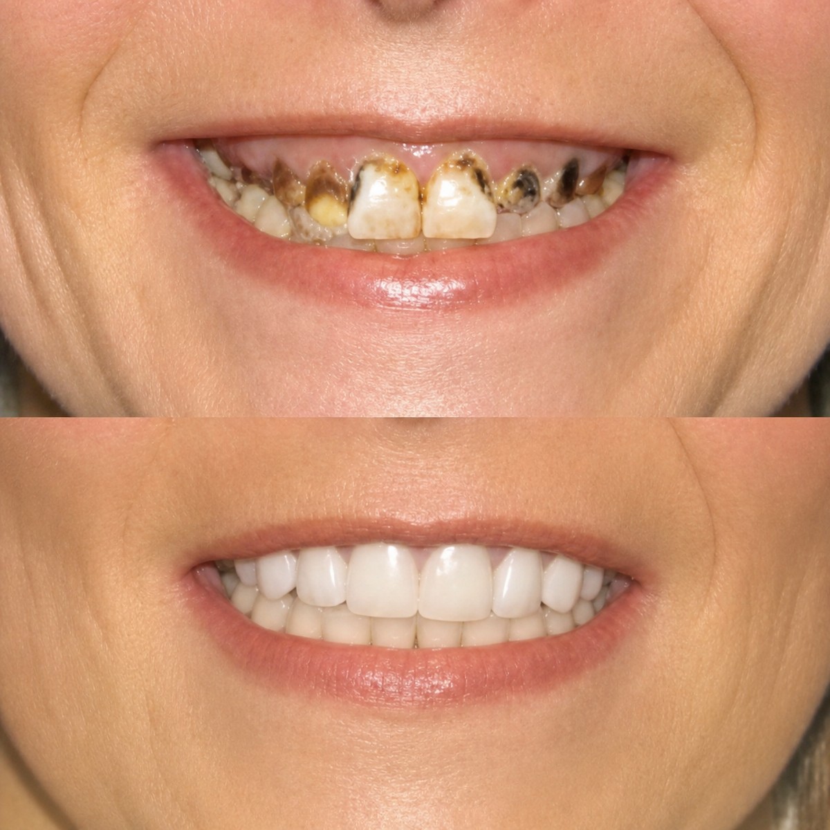 Antes y después de coronas de zirconio en Memorial Bahçelievler Hospital, resultado de sonrisa