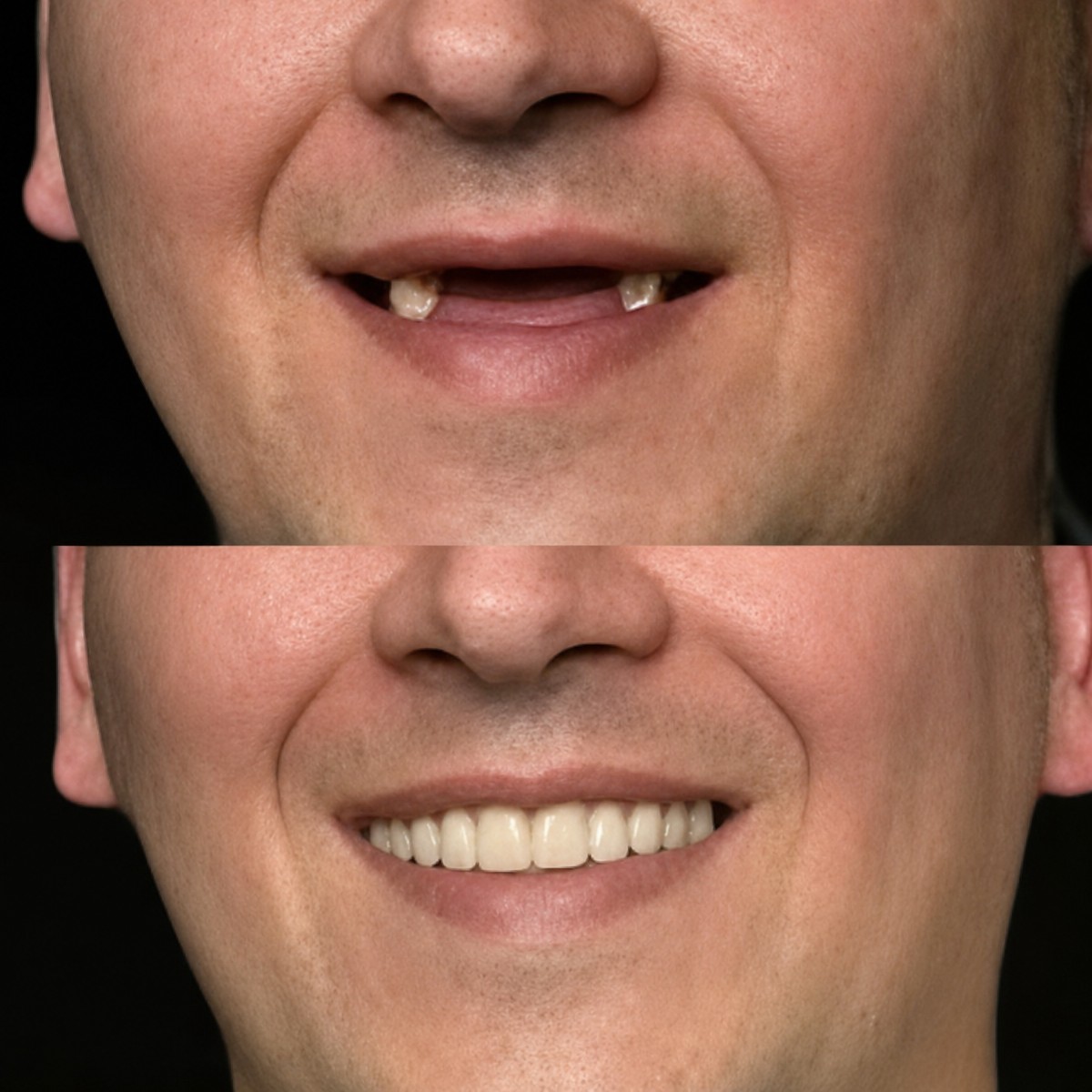 Antes y después de coronas de zirconia en Memorial Bahçelievler Hospital, resultado de sonrisa