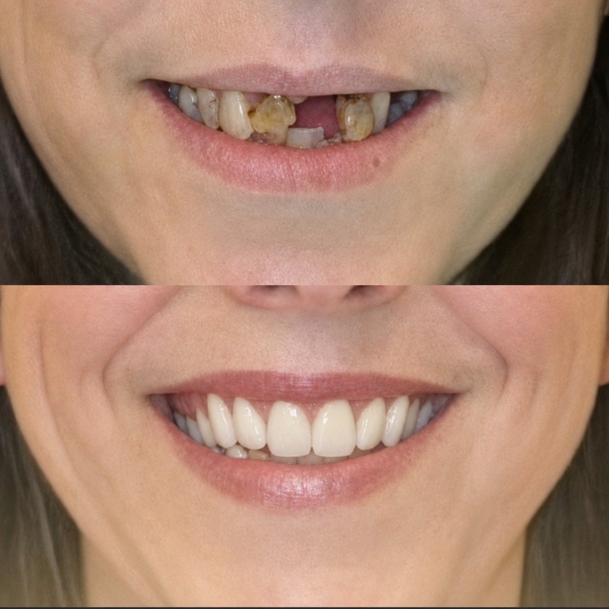 Resultados antes y después de coronas de zirconia en Memorial Bahçelievler Hospital, sonrisa restaurada