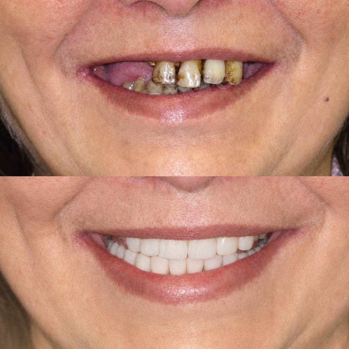 Resultados antes y después de coronas de zirconio en Memorial Bahçelievler Hospital, sonrisa