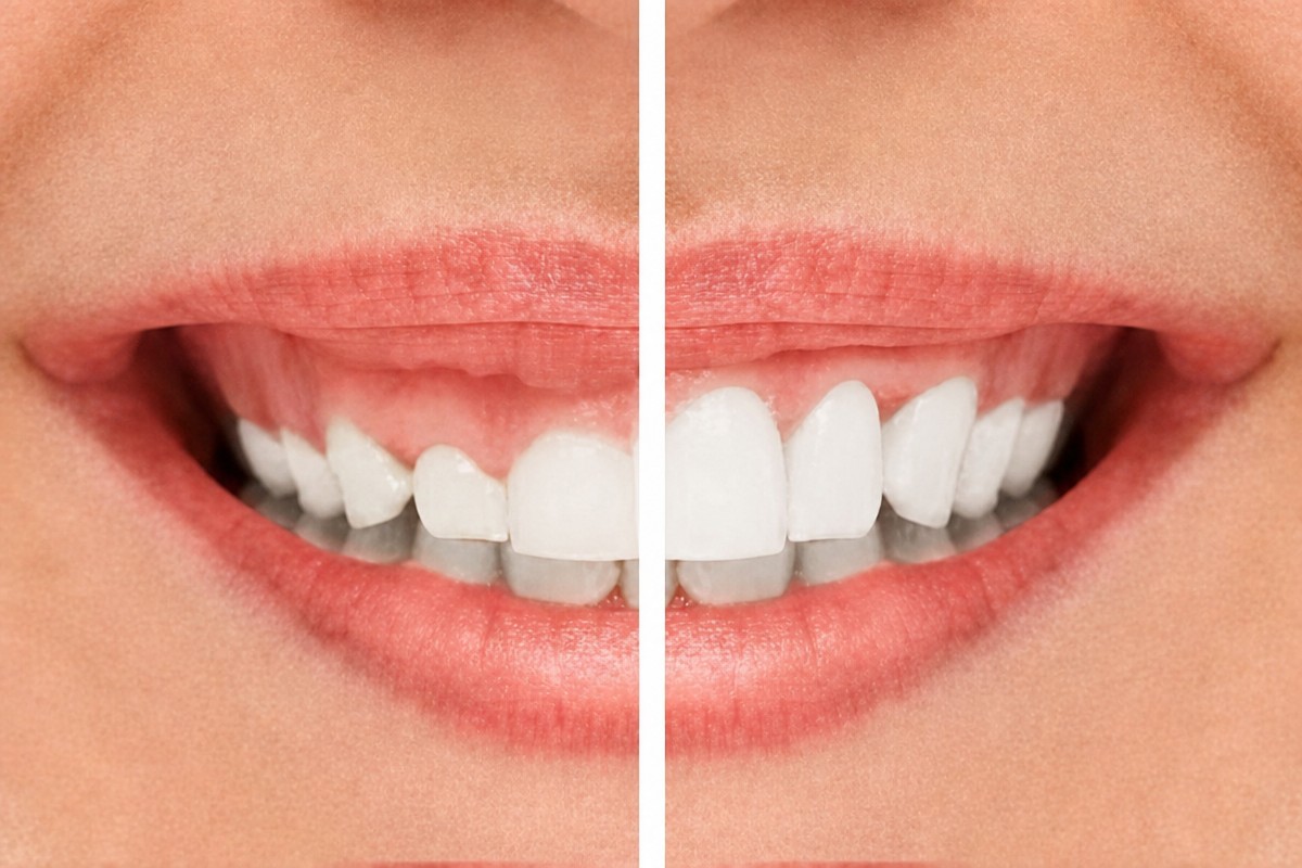 Résultats avant/après gingivectomie à Adem and Havva Medical Center, contour gingival amélioré