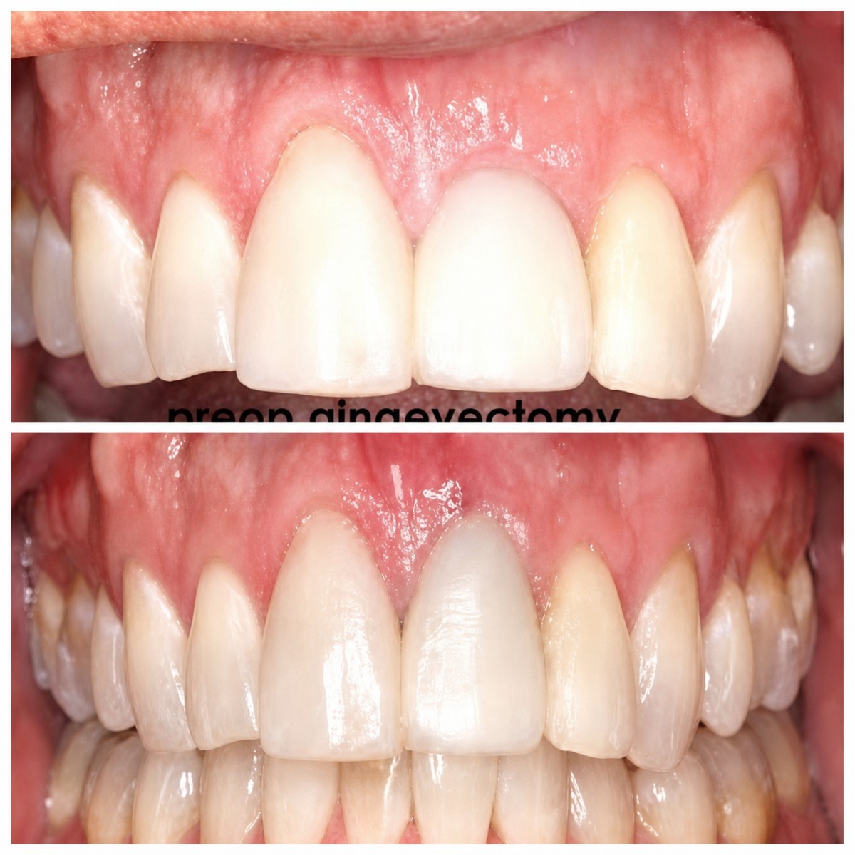 Résultats avant et après gingivectomie à Adem and Havva Medical Center, contour gingival amélioré