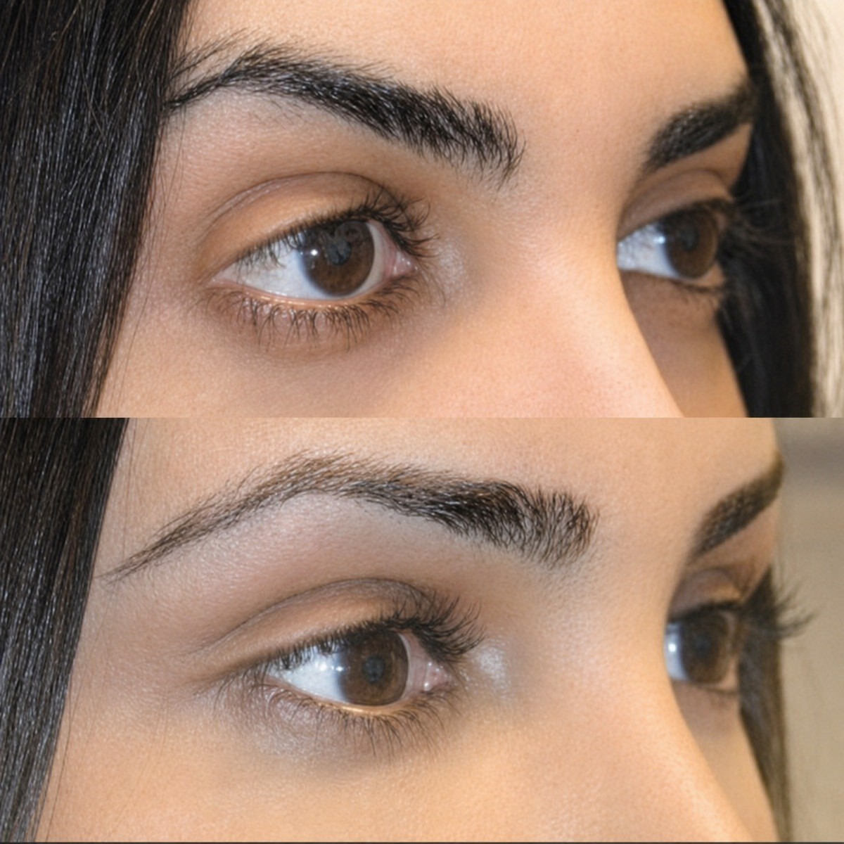 Resultado antes y después de feminización facial en Memorial Bahçelievler Hospital, zona ocular