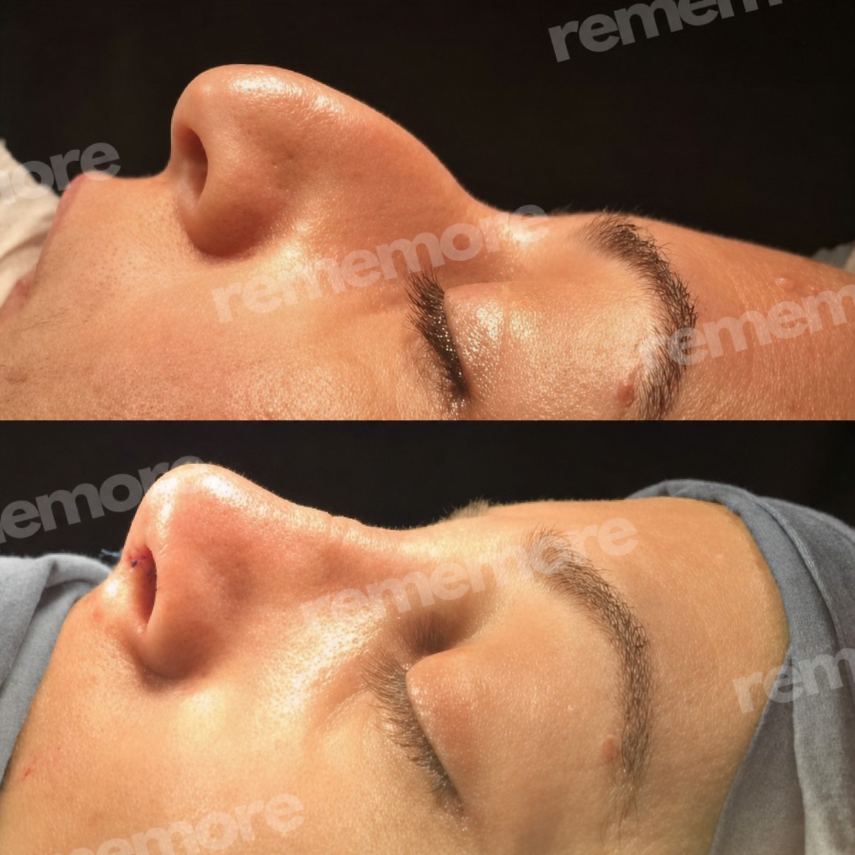 Before and after open rhinoplasty results at Memorial Şişli Hospital, improved nose shape