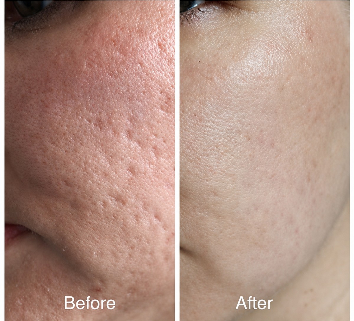 Before and after Morpheus8 skin tightening results at ID Clinic Bangkok, smoother facial skin