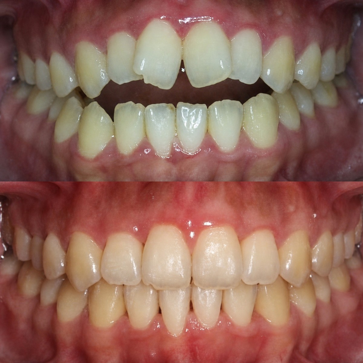 Résultats avant/après Invisalign à la clinique Hospitaprime, amélioration de l’alignement